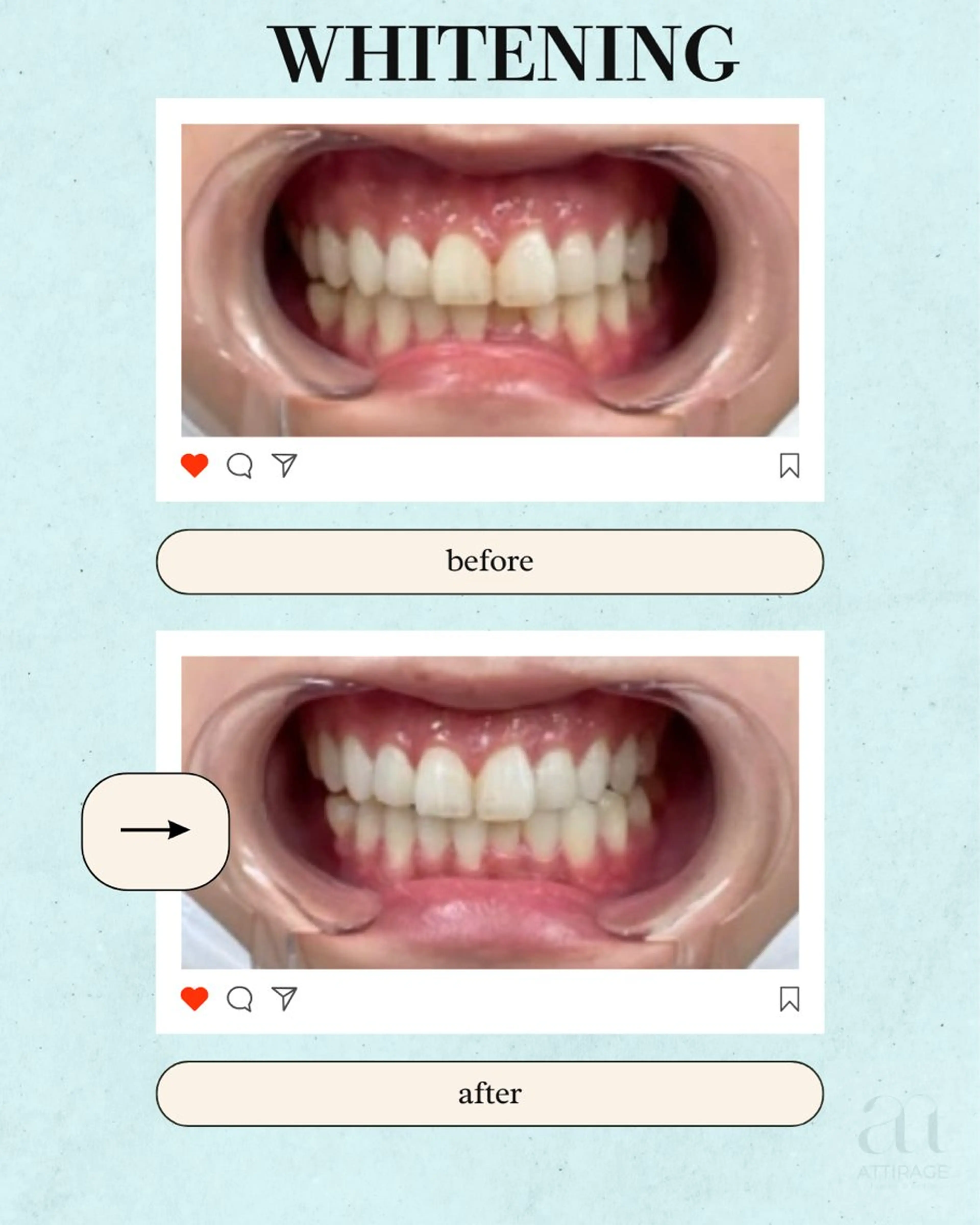 ⭐︎ホワイトニング⭐︎８分2セット⭐︎の写真