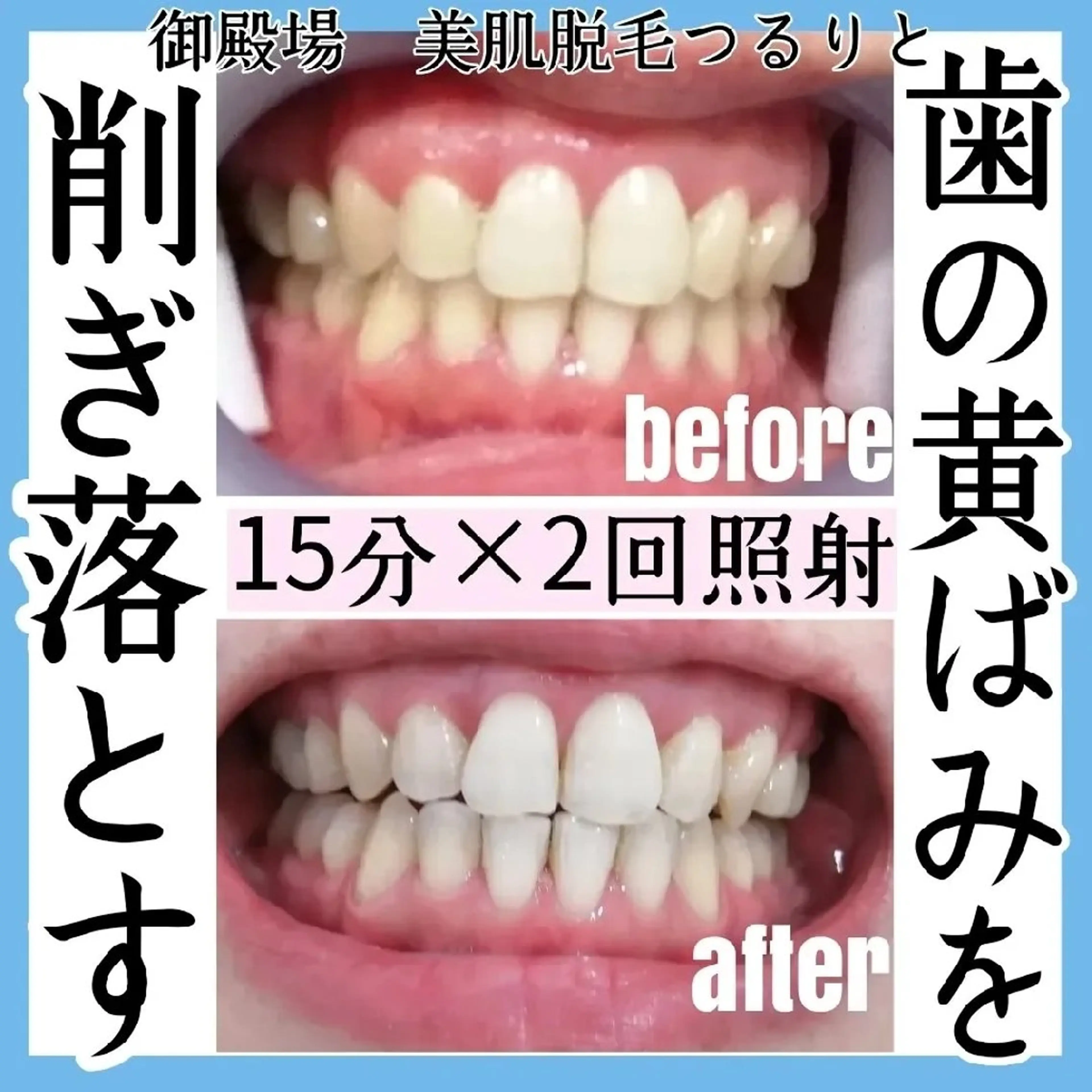 当日予約🆗セルフホワイトニング🦷✨約45分でトーンアップ‼️の写真