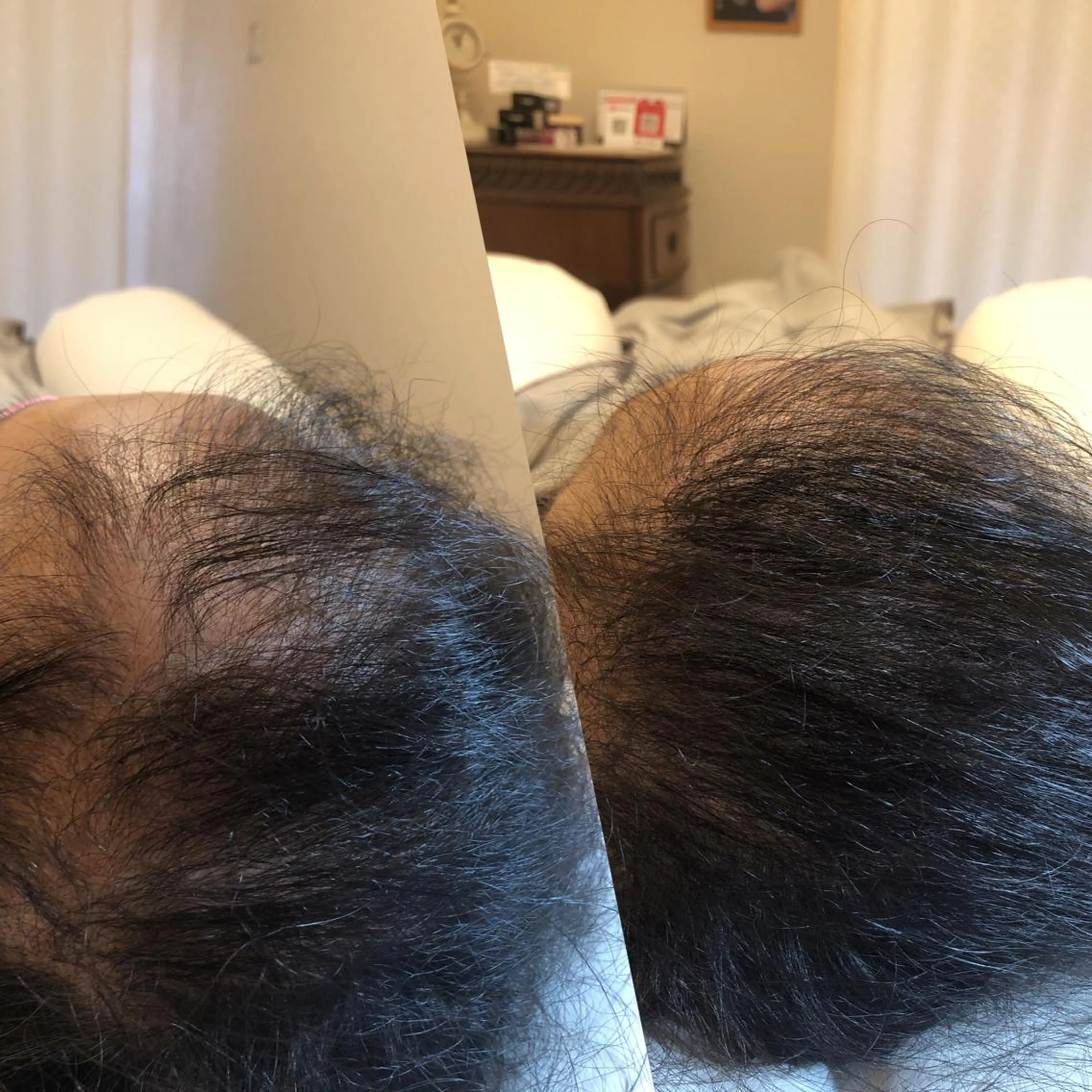 ヘア増毛　ボリュームアップ　ヘアーエクステ400本の写真