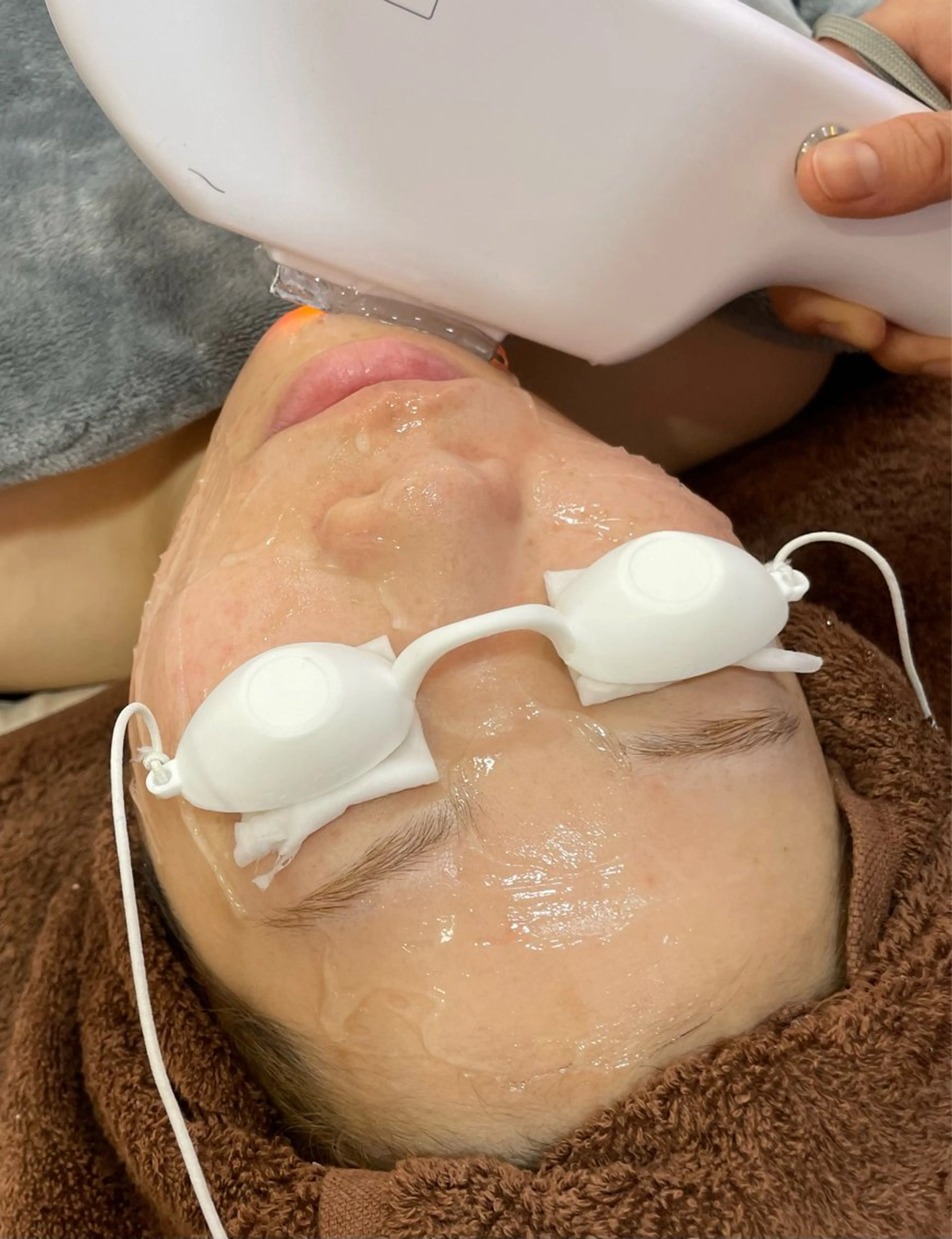 【全顔】毛穴の開きも改善・産毛がなくなることで化粧ノリも良くなる♪の写真