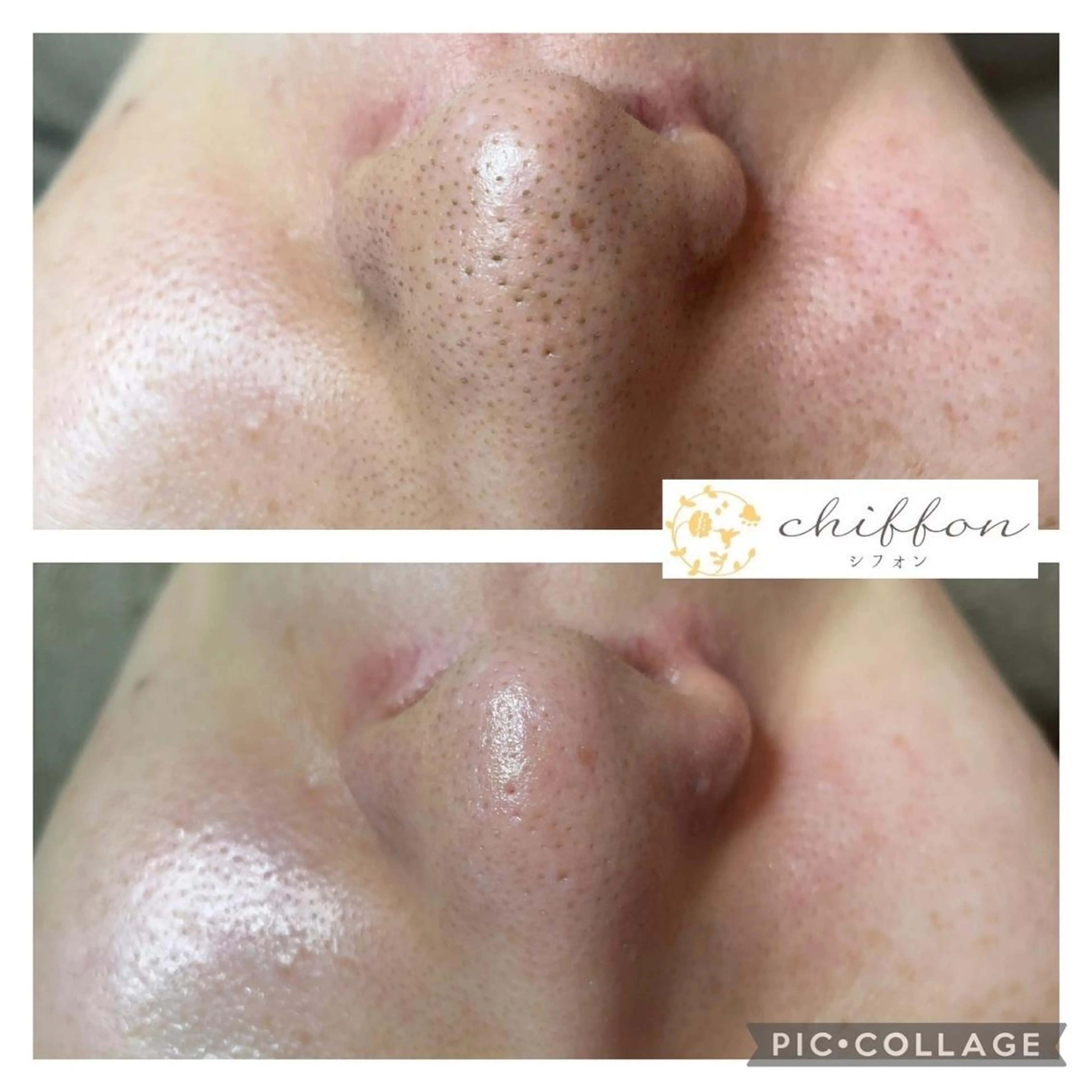 エステ 毛穴黒ずみ改善🥇 ✨シフォン豊田✨のエステ・リラクイメージ