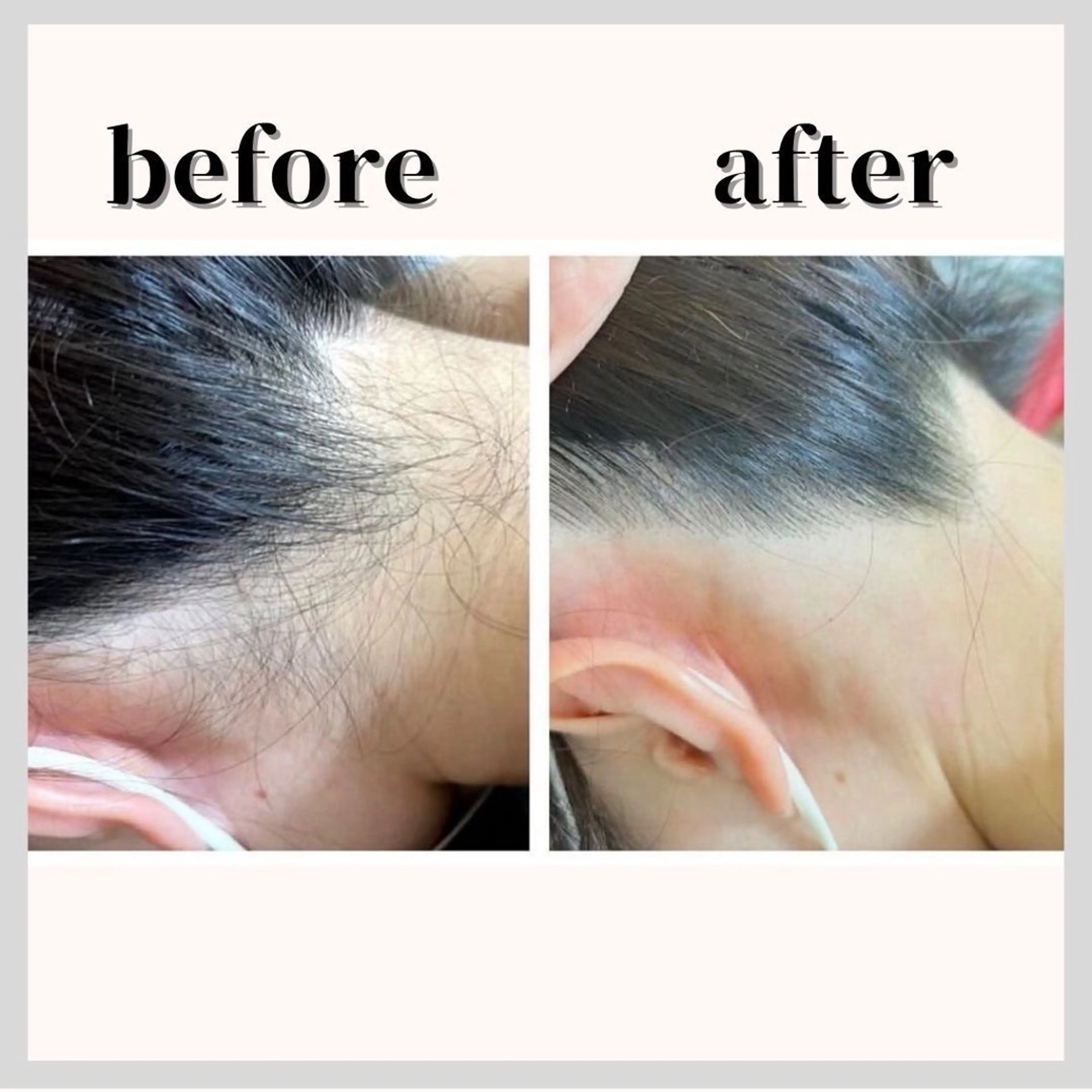 脱毛 温活beautyサロンNeroli所属・切らない脂肪吸引🔥 Neroliまりこのエステ・リラクイメージ