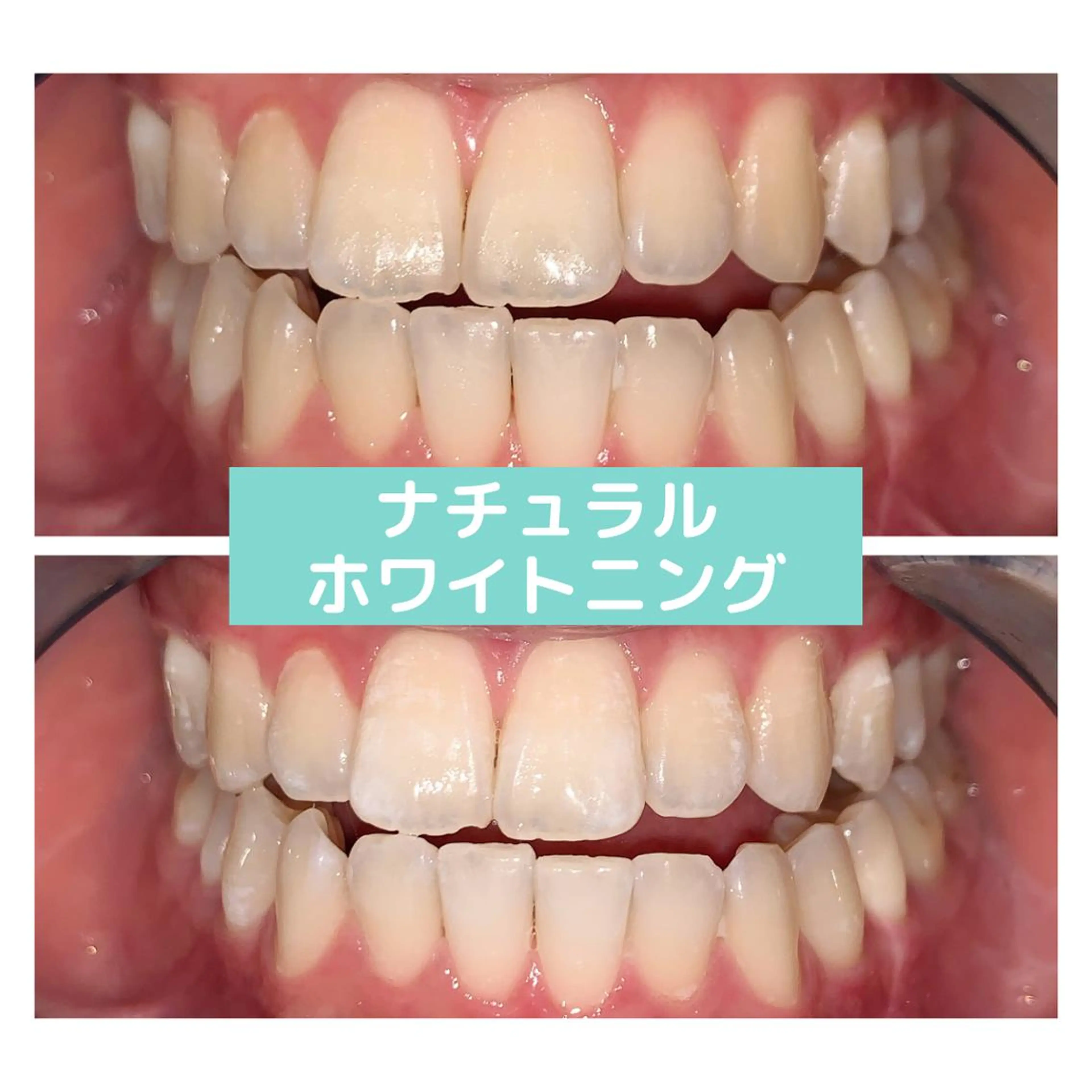 その他 ホワイトニング｜韓国式3D毛穴洗浄 lonhana ﾛﾝﾊﾅ所属・韓国式3D毛穴洗浄 lonhanaのその他イメージ