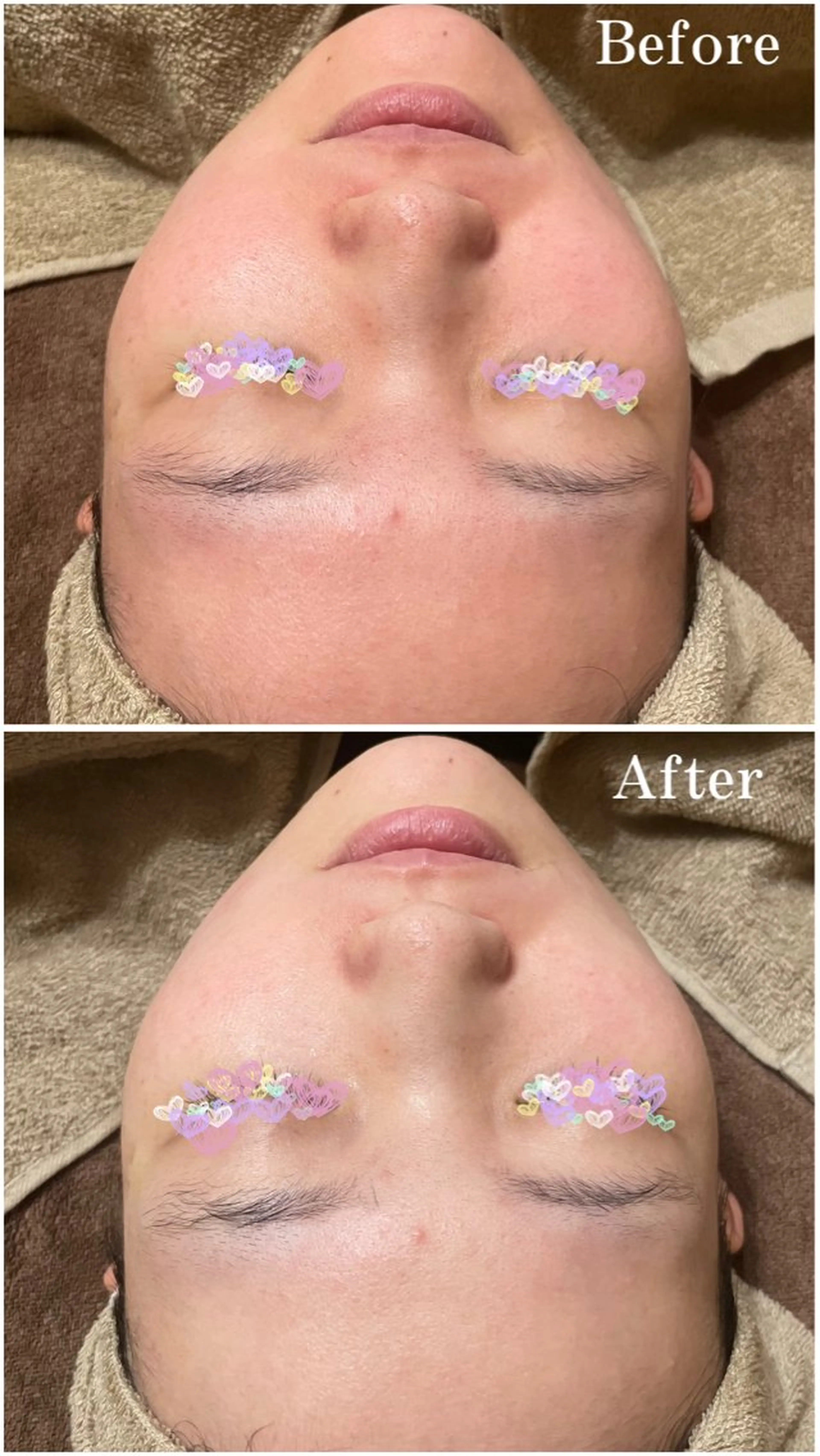 生コラーゲン導入+パックコースの写真