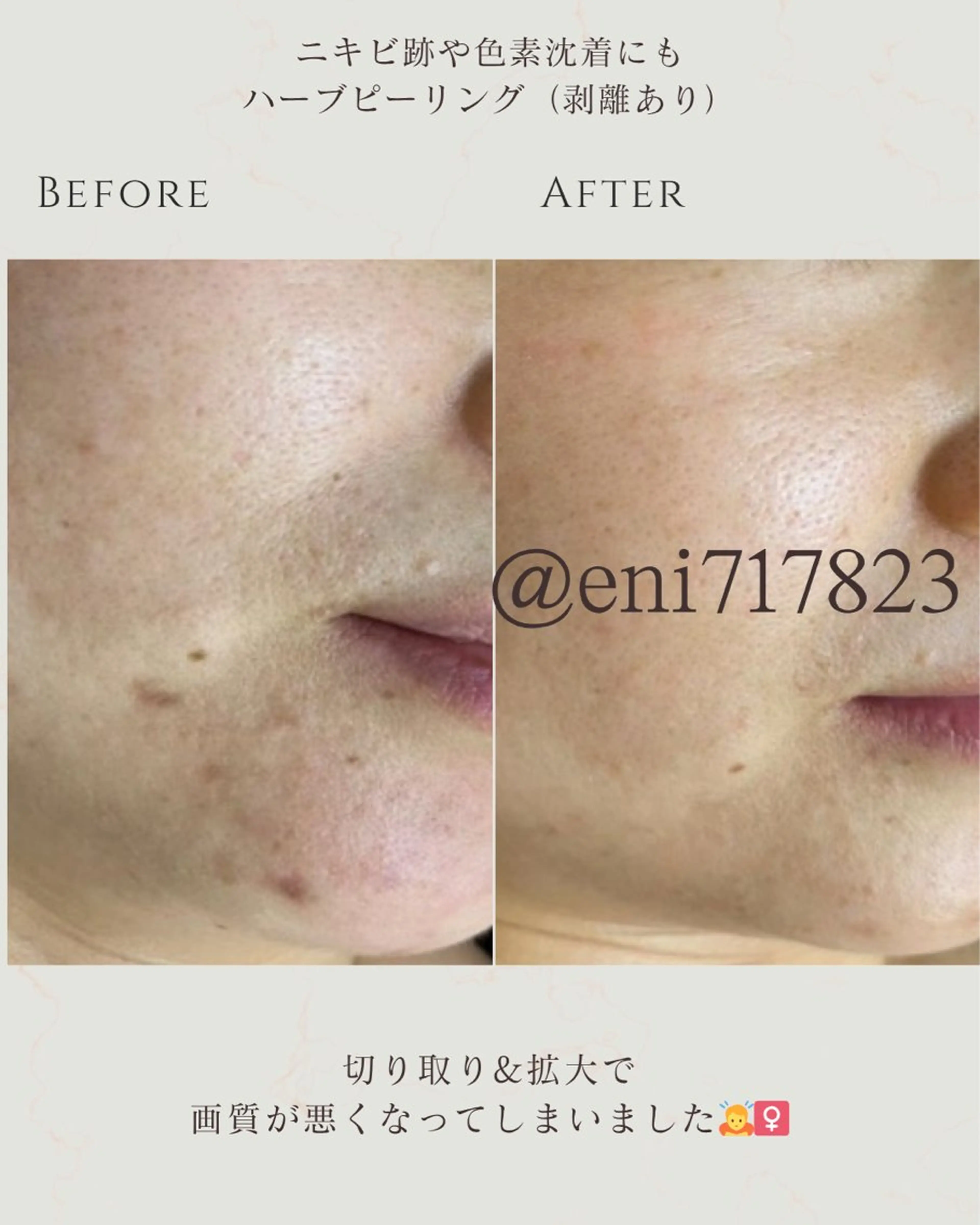 エステ シミ毛穴|眉Wax THE flowのエステ・リラクイメージ