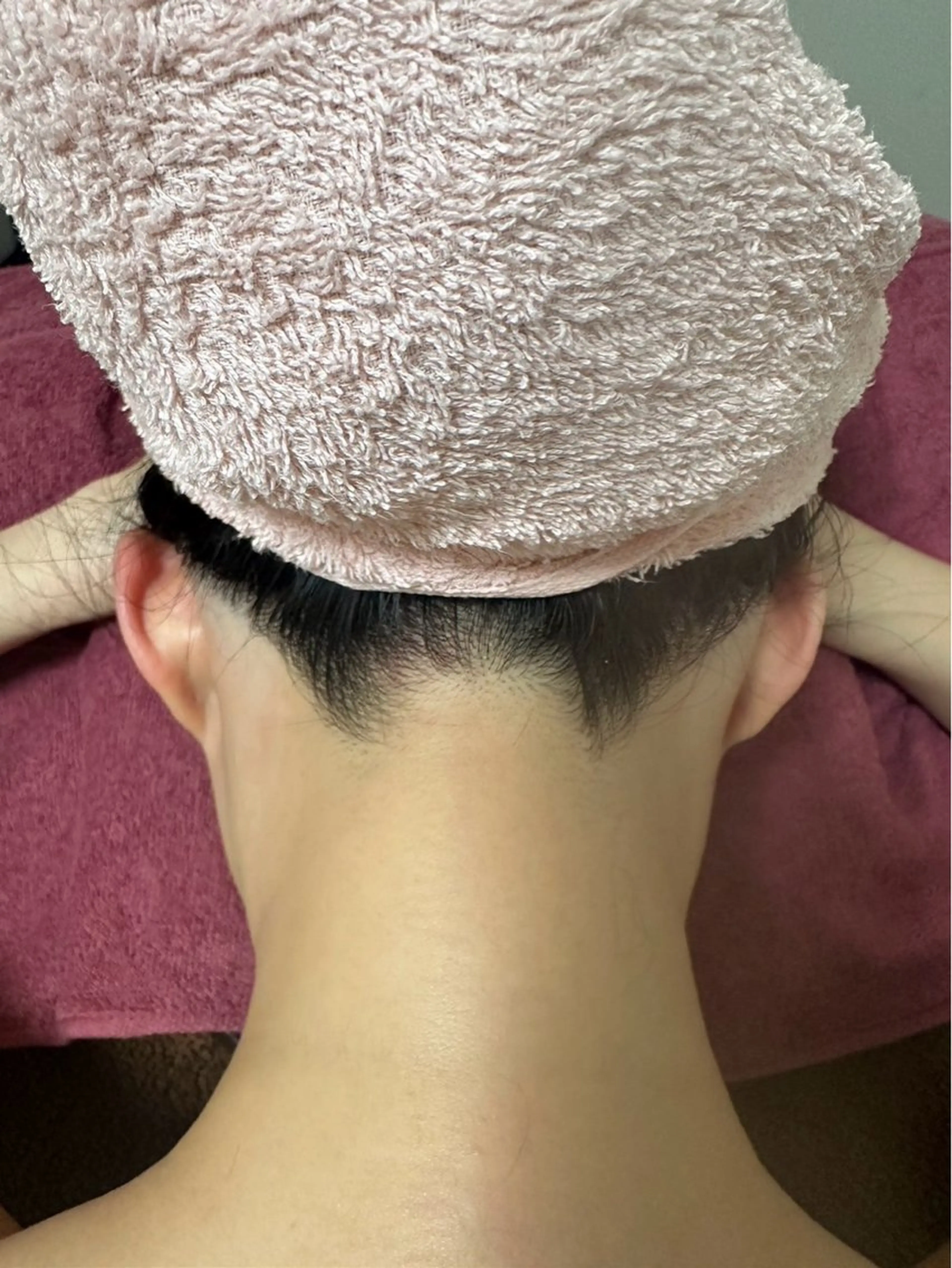 うなじ脱毛一回の写真