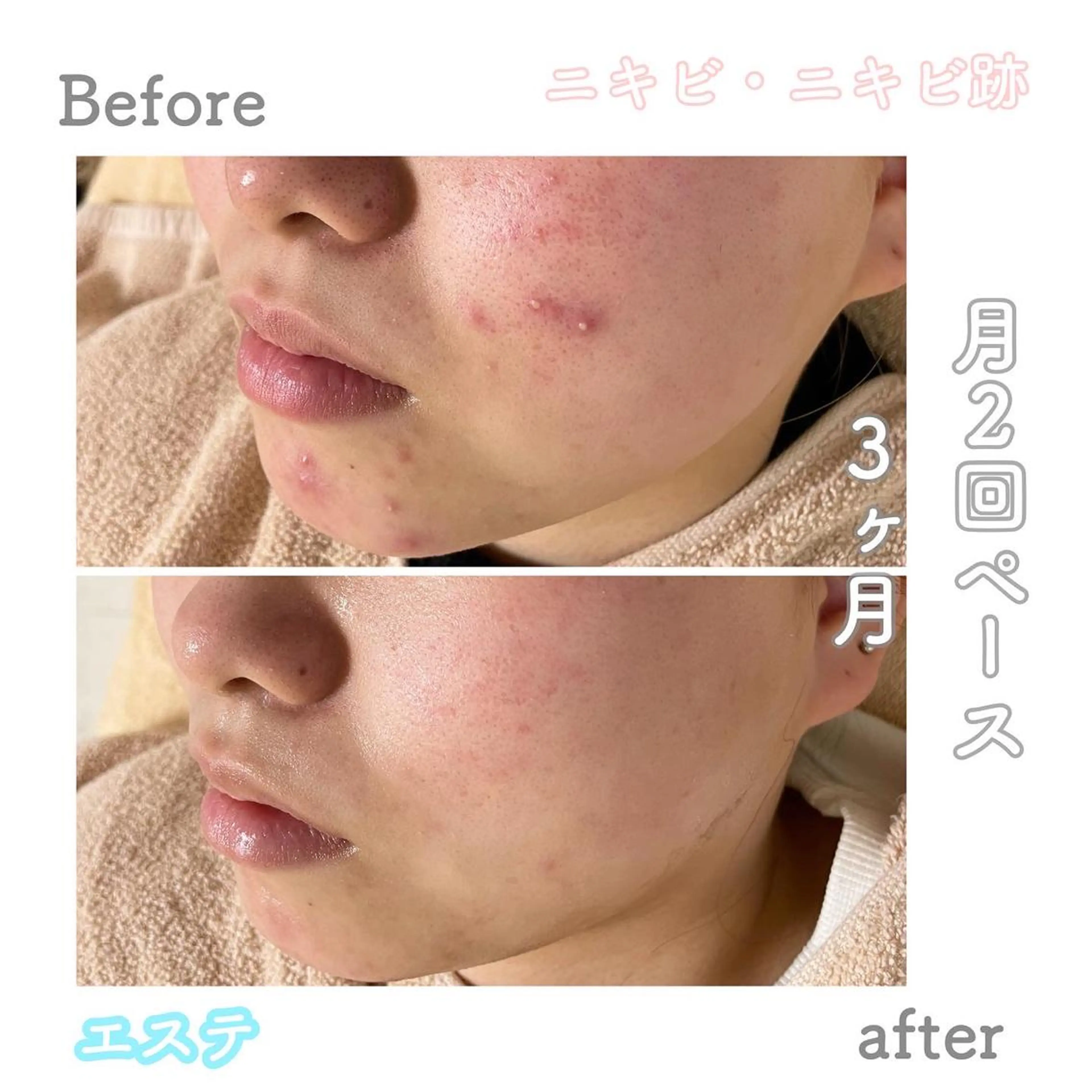 ショート カラー パーマ ヘアアレンジ メンズ キッズ ネイル マツエク・マツパ アイブロウ エステ ニキビ&跡改善サロン オーナー光木のエステ・リラクイメージ