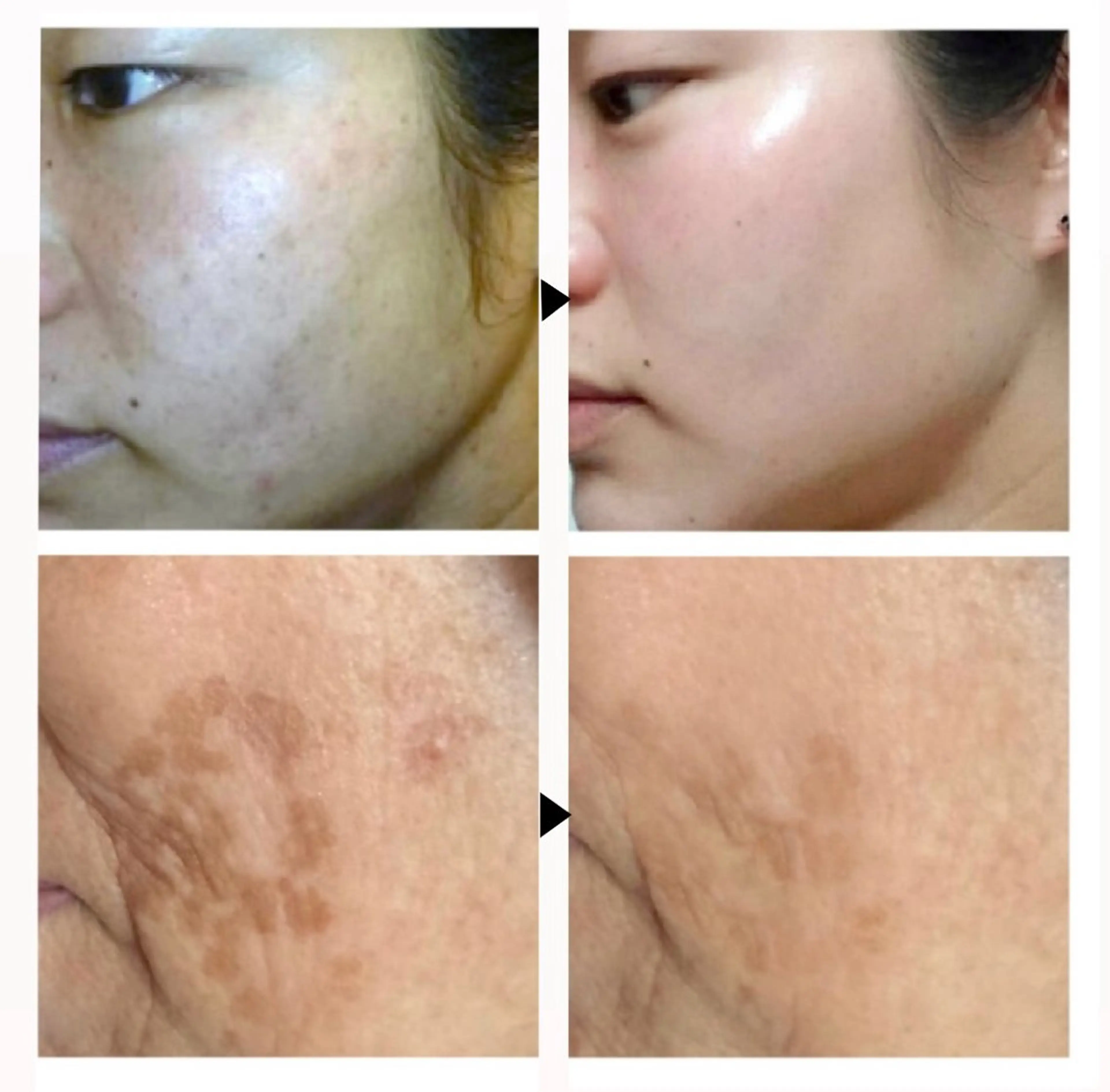 【シミ改善】レーザーを使わない次世代ピーリング！シミケア¥13,500→¥12,500の写真