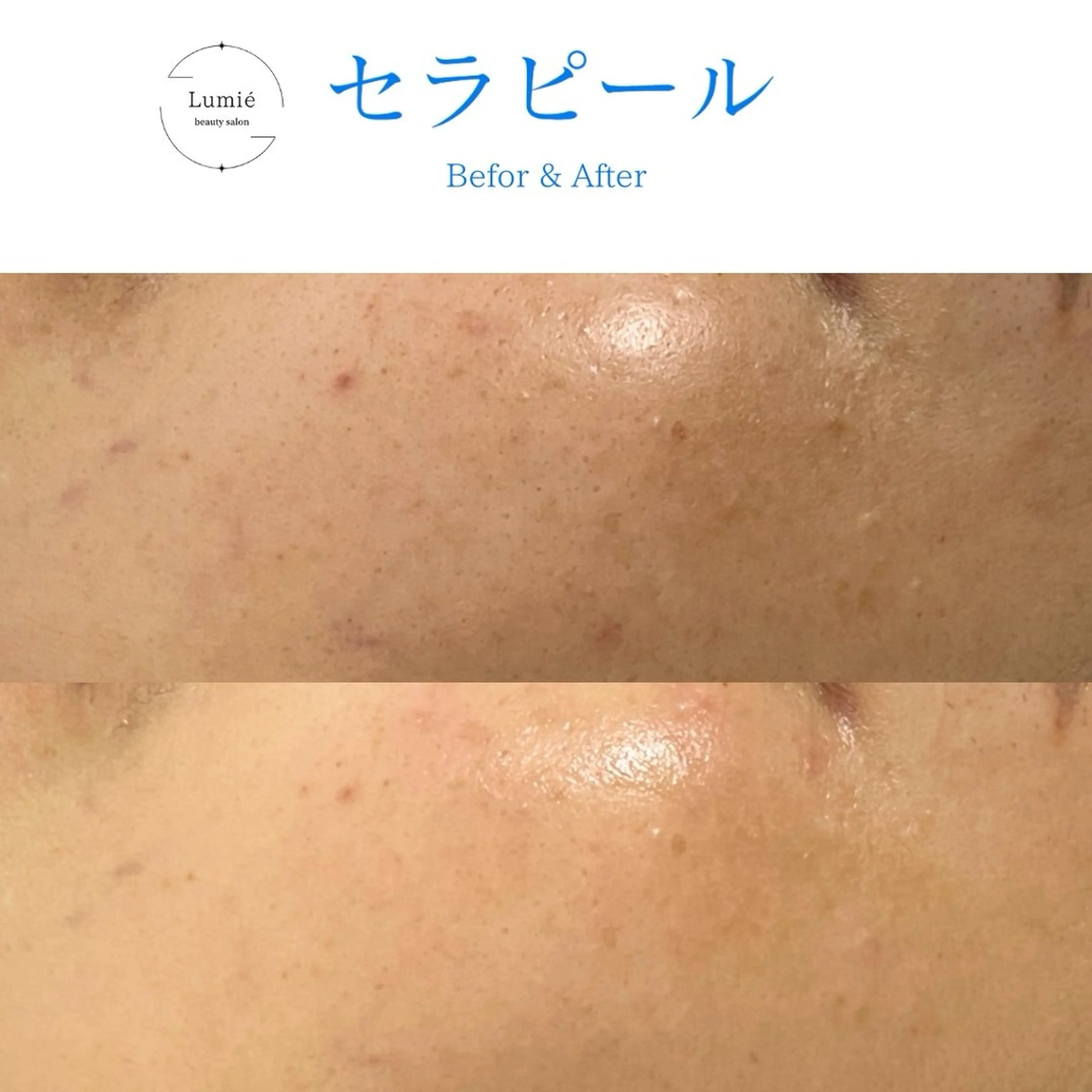 肌育専門サロンLumie所属・水玉リフティング🫧 Lumie恵比寿店のエステ・リラクイメージ