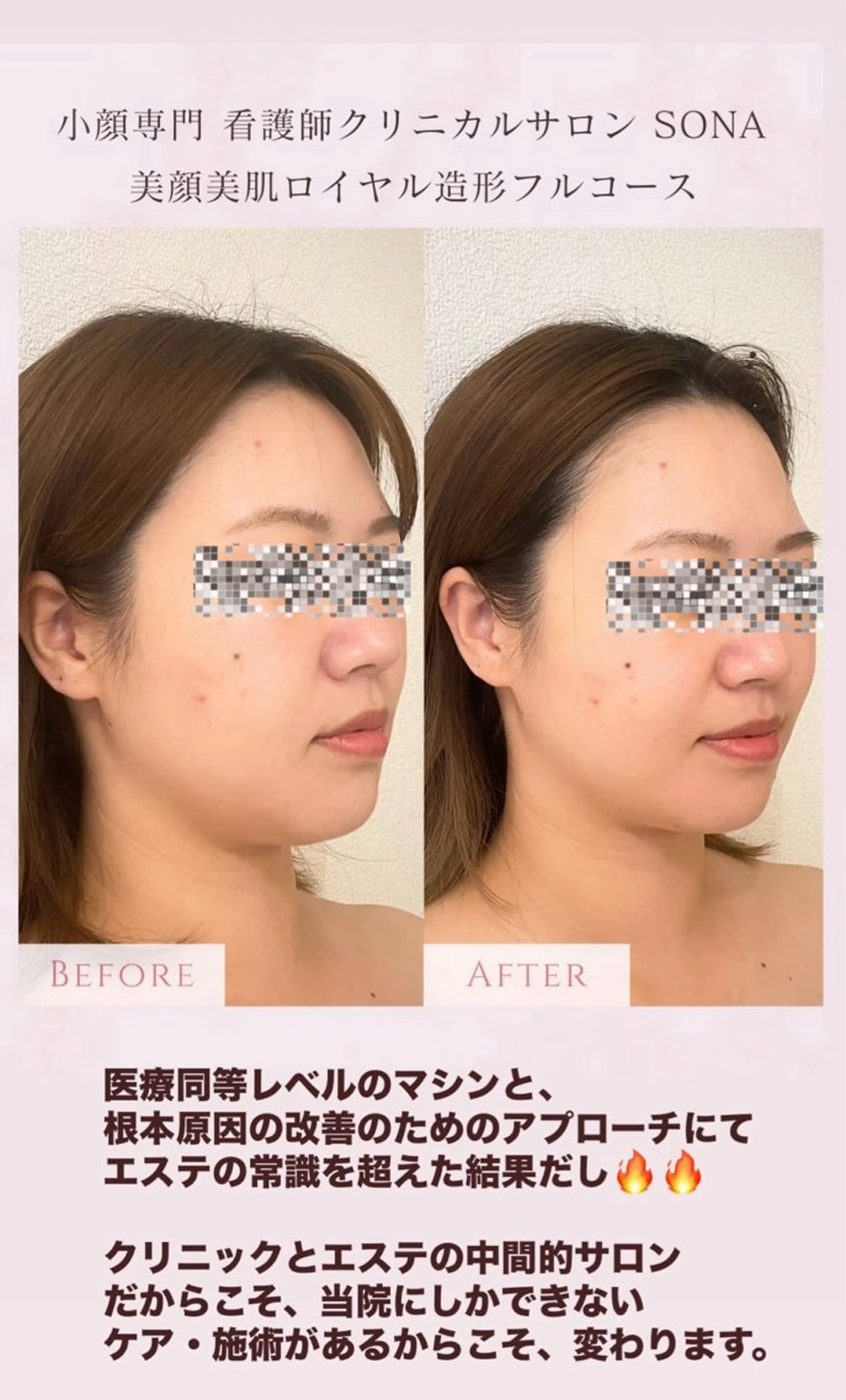 エステ 小顔/たるみ/黒ずみ除去専門サロン/SONA 大和西大寺店所属・【小顔専門看護師 サロンSONA】のエステ・リラクイメージ