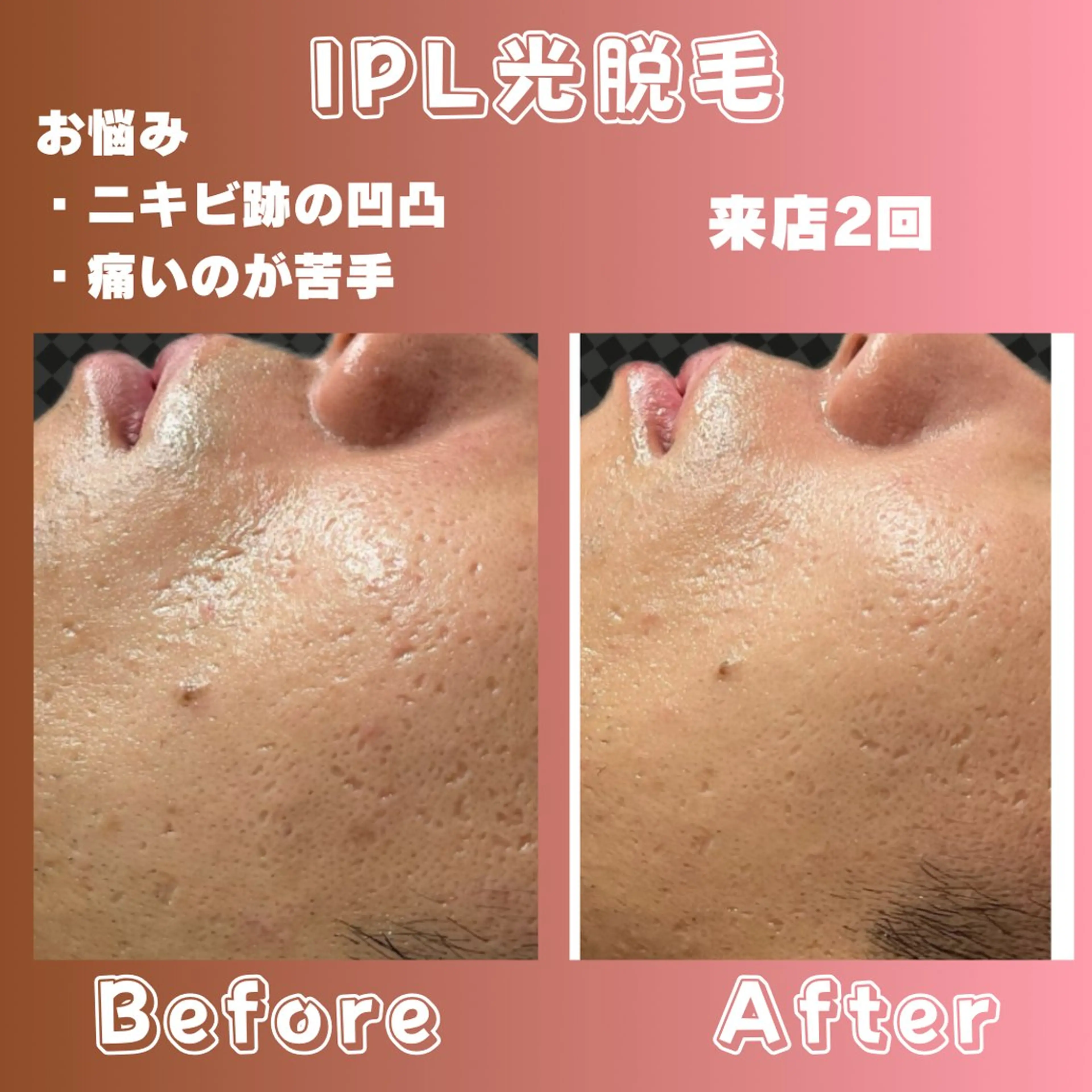 性別関係なく♡垢抜け全身脱毛♡（顔とVIO無し）初回限定❣️光の効果で♡ニキビ跡の凹凸、気になる黒ずみ、くすみさよならの写真