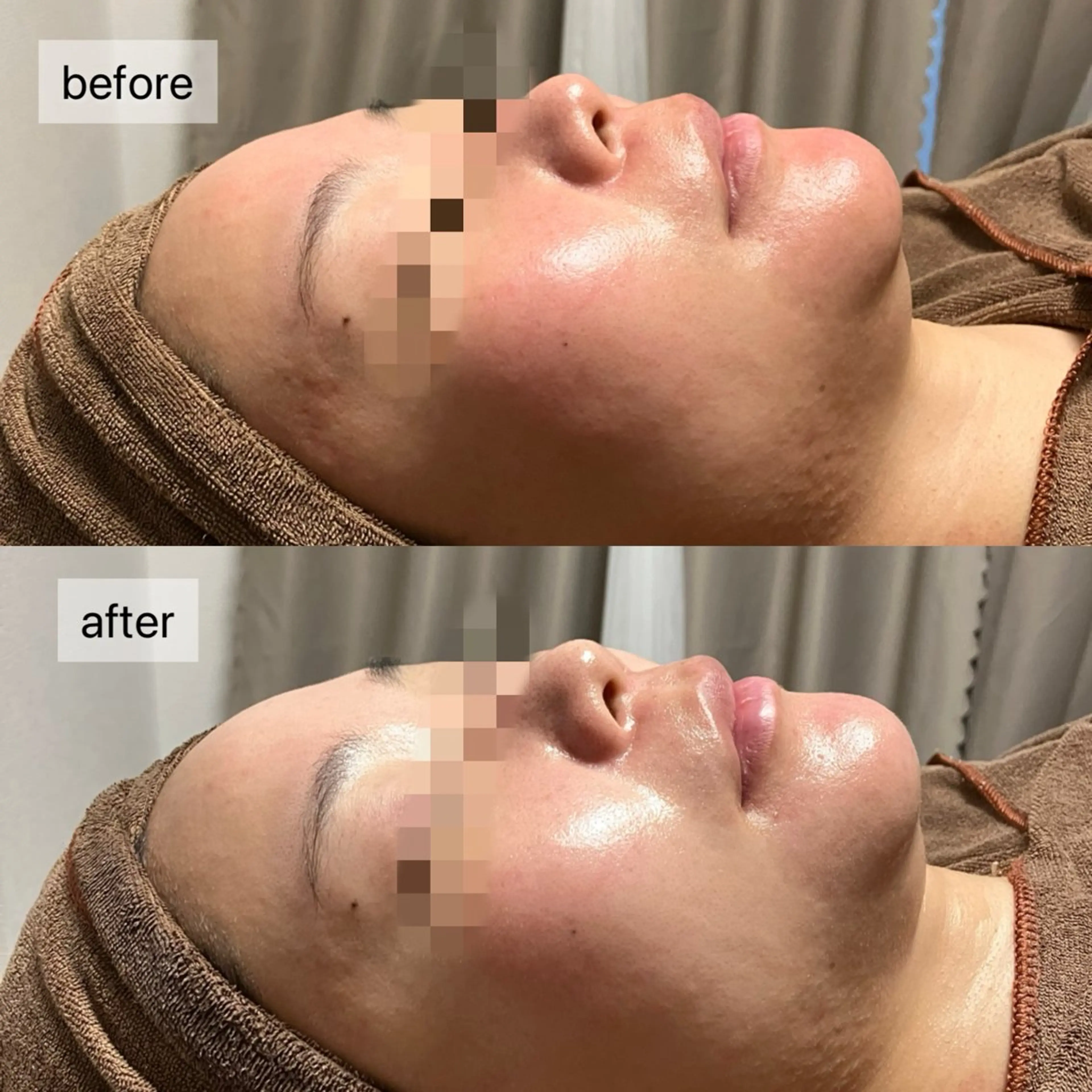 エステ HINANO矢場町店【ヒナノ】所属・脱毛/肌改善🌿 HINANO 村田のエステ・リラクイメージ