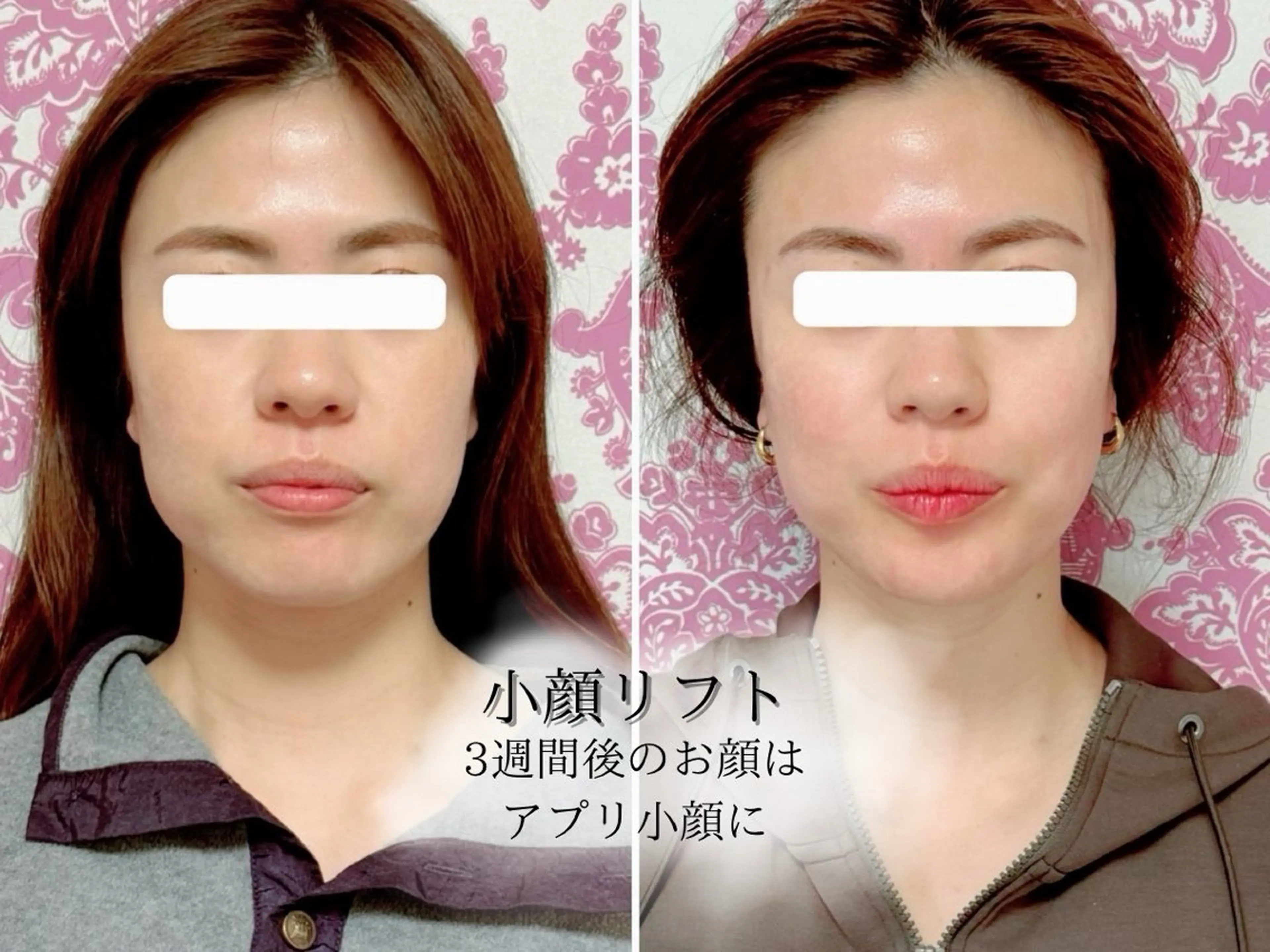 🩵minimoセール🩵【 ウルトラリフト＋ヒト幹細胞培養液 】リフトアップ＆小顔🙌🏻💕の写真