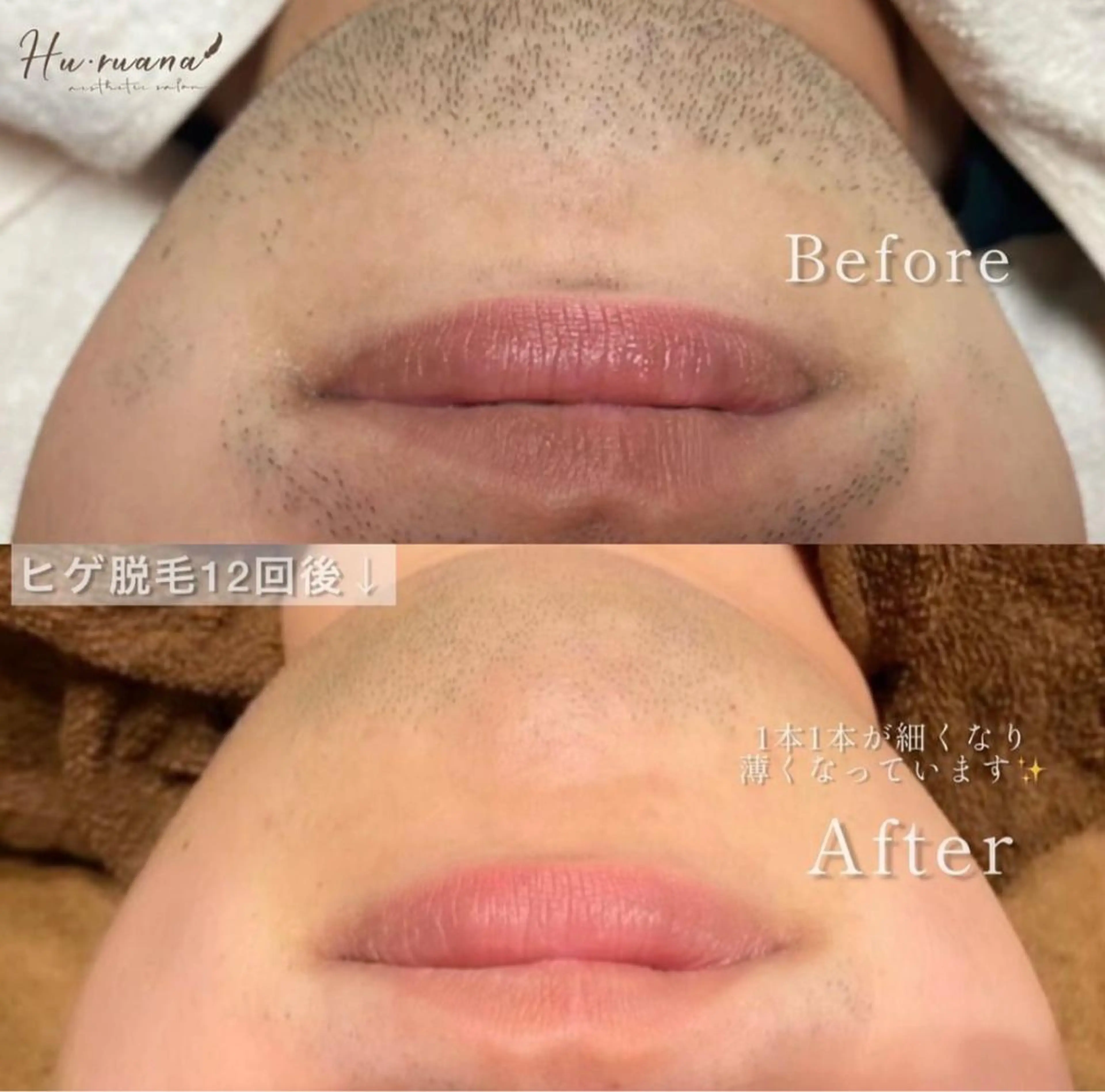 メンズヒゲ脱毛✨の写真