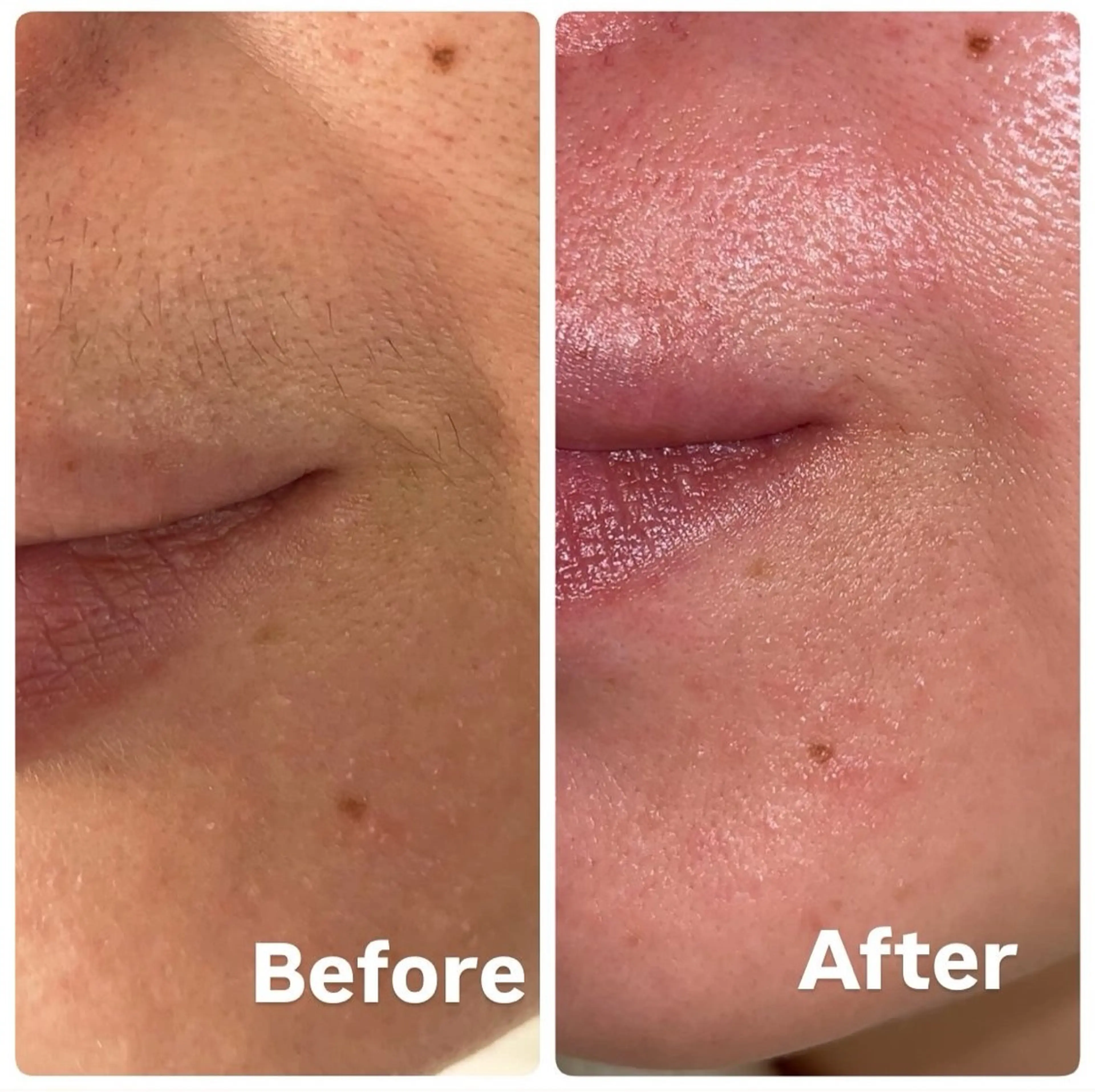 【美肌シュガーリング】脱毛⭐︎お顔orうなじの写真