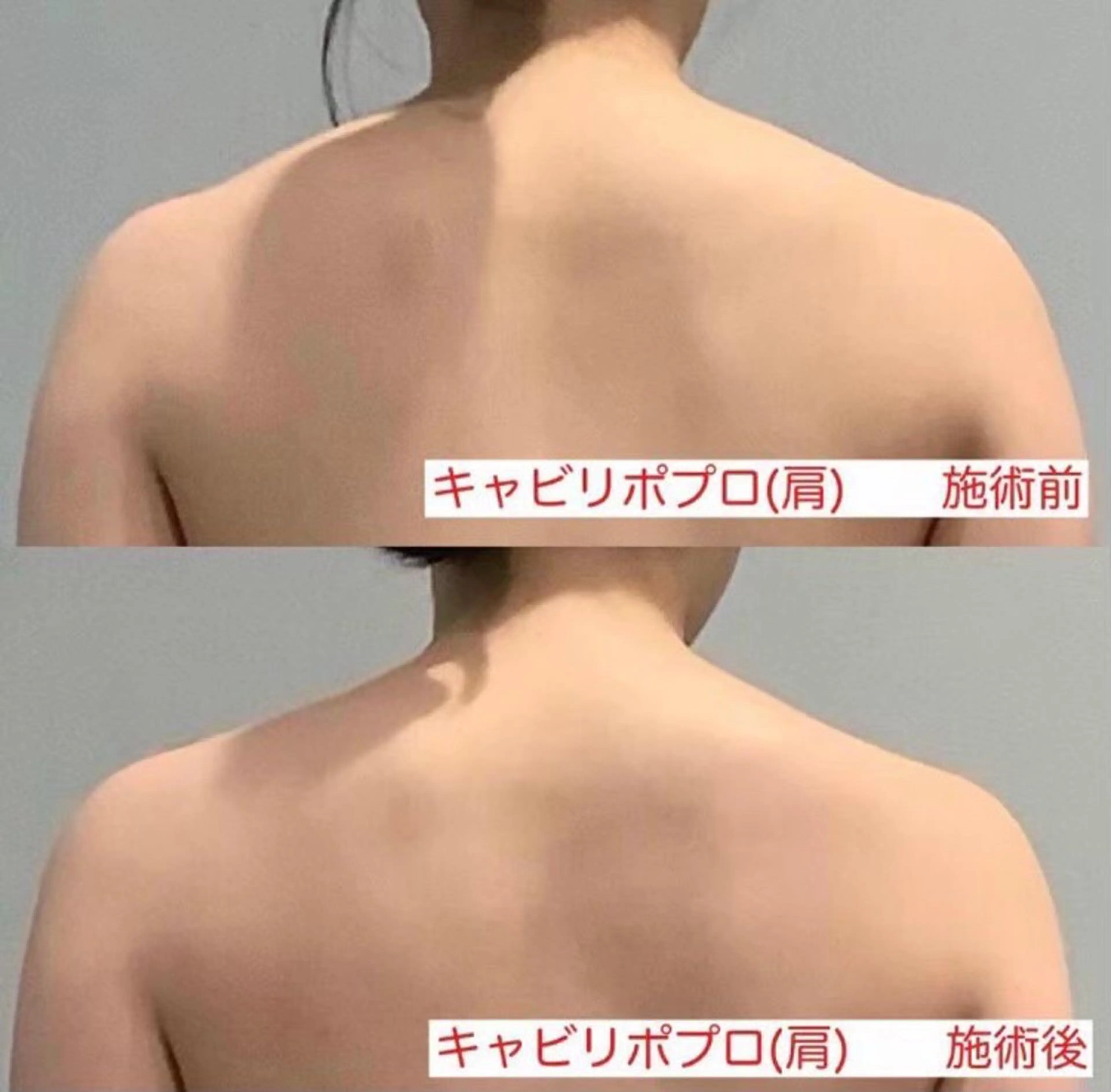 【肩コリ】【肩甲骨~首付根/肩】最新ボディマシンでガッツリケア🔥“ゴツ見え”の原因！肩の盛り上がりにも◎の写真