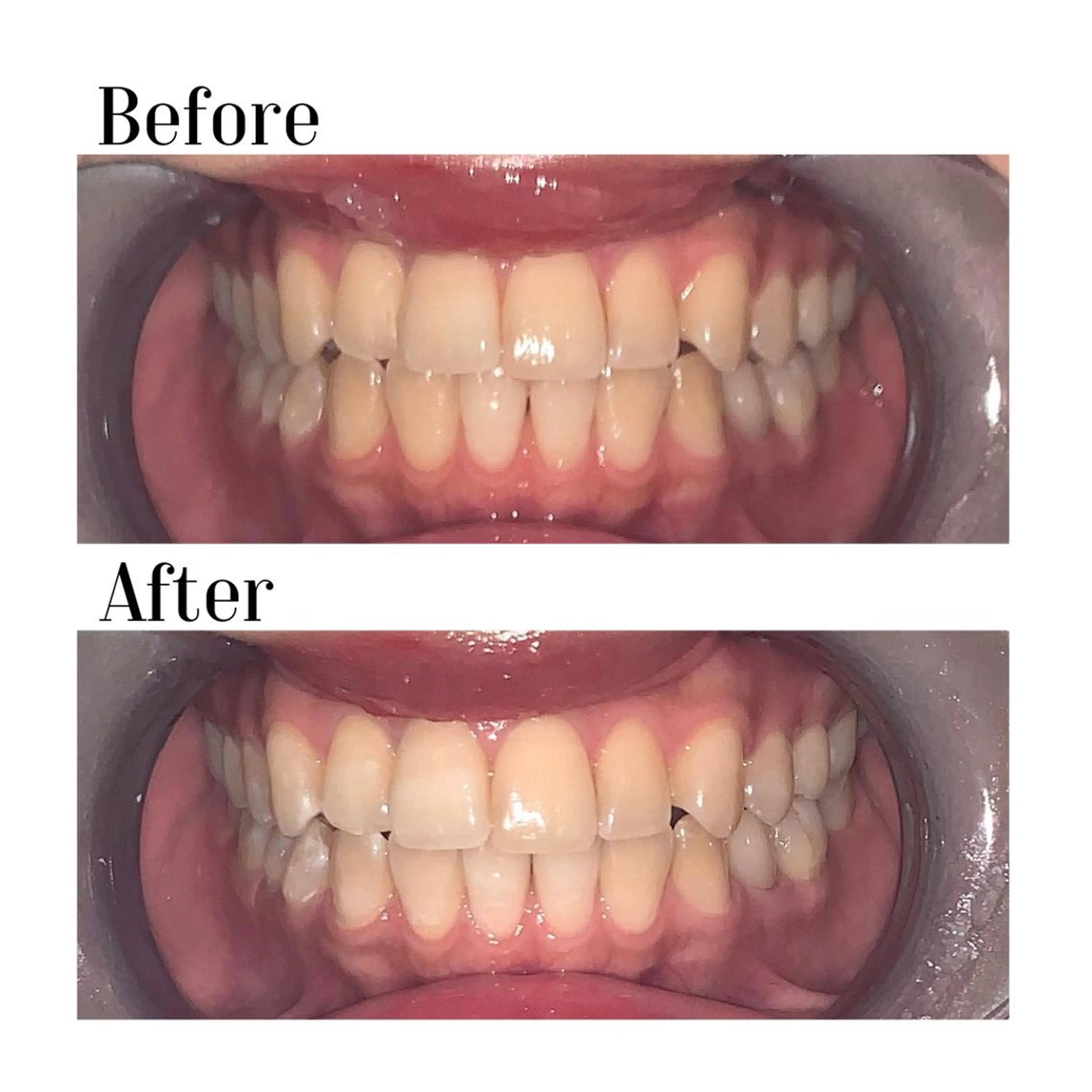 その他 ホワイトニング|韓国式3D毛穴洗浄 lonhana ロンハナ所属・韓国式3D毛穴洗浄 lonhanaのその他イメージ