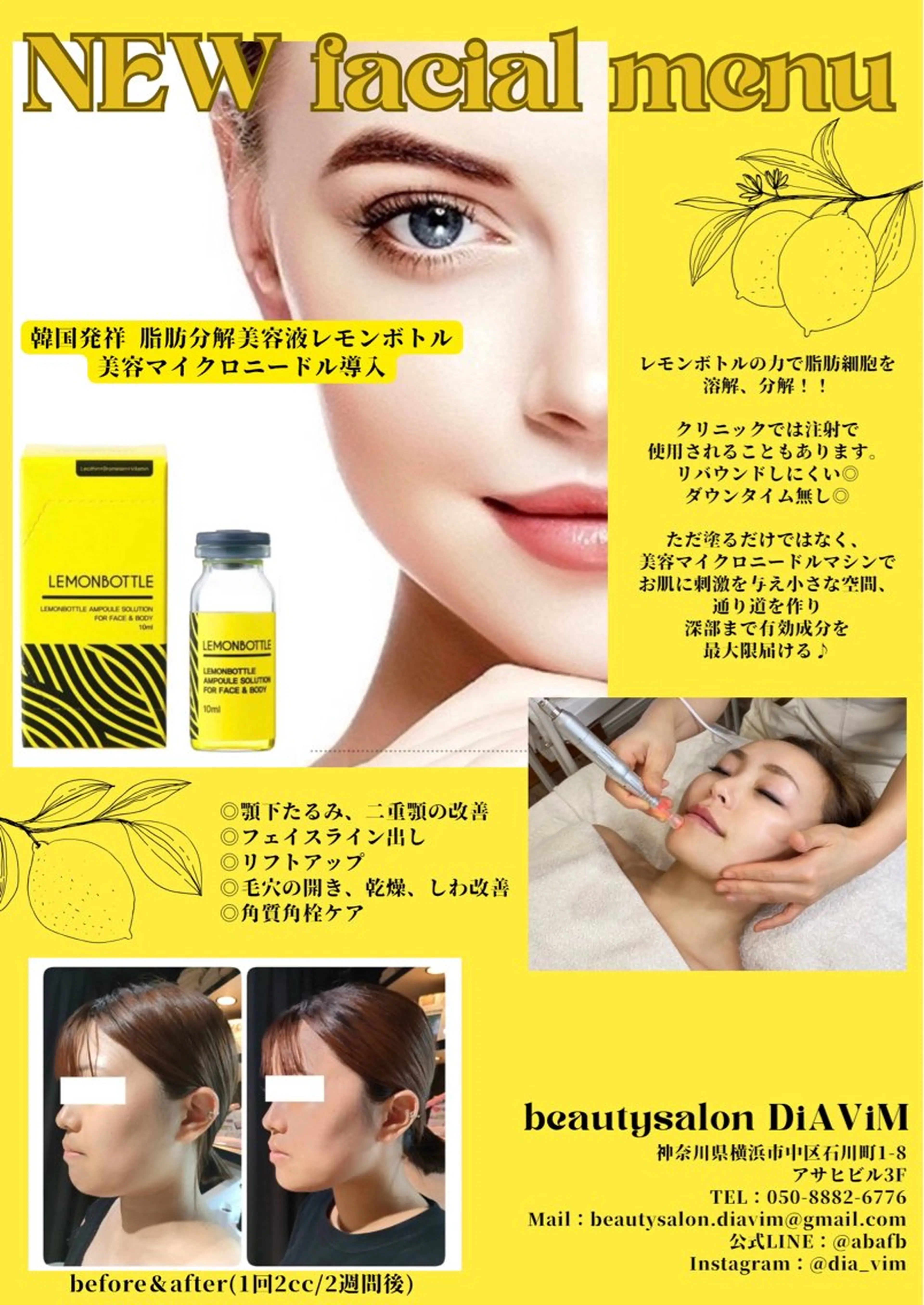 【大人気✨】韓国発祥◆最新脂肪美容液🍋➕美容マイクロニードル導入¥11,000の写真