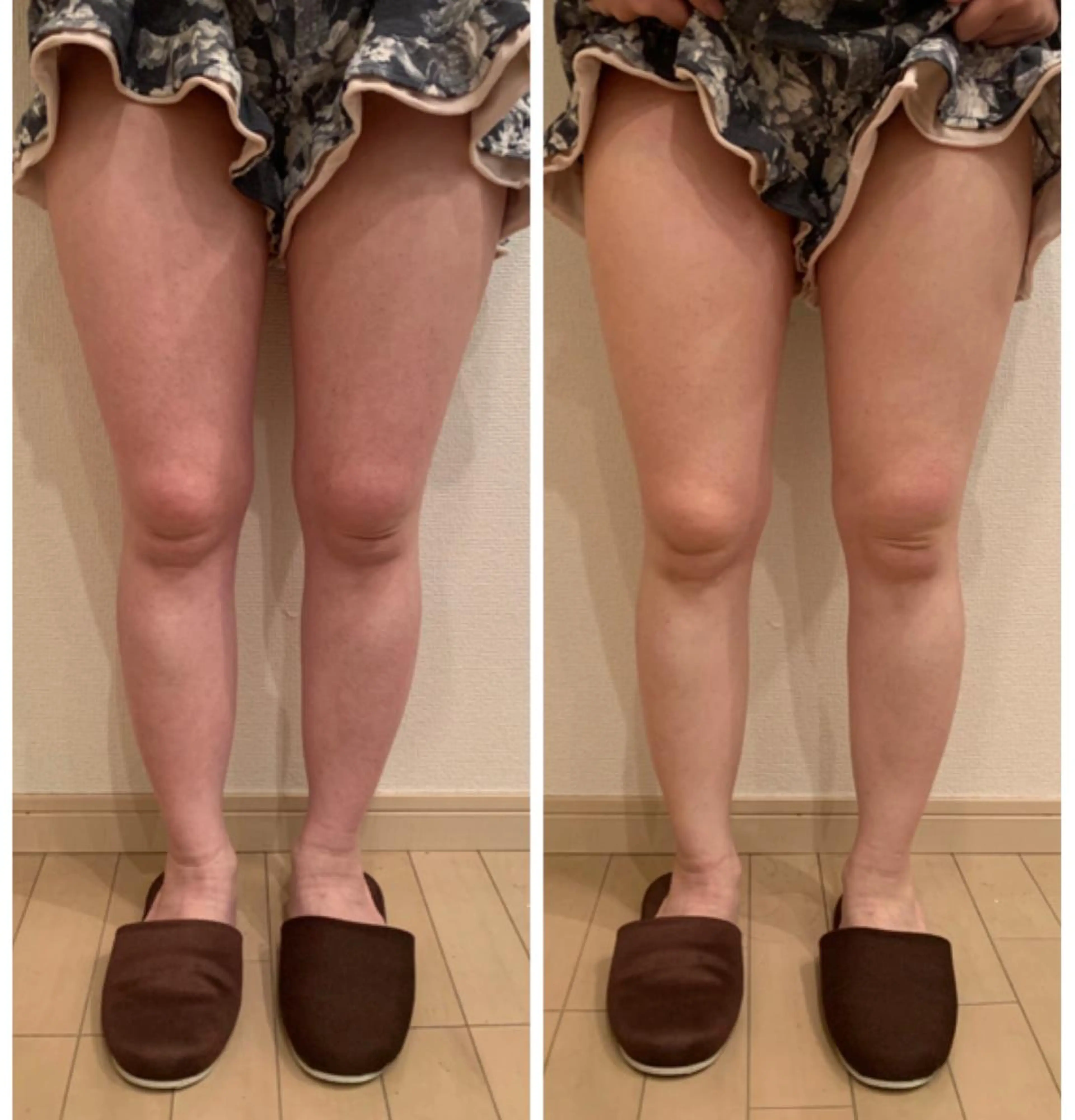 【キャビテーション】脚痩せコース🦵✨の写真