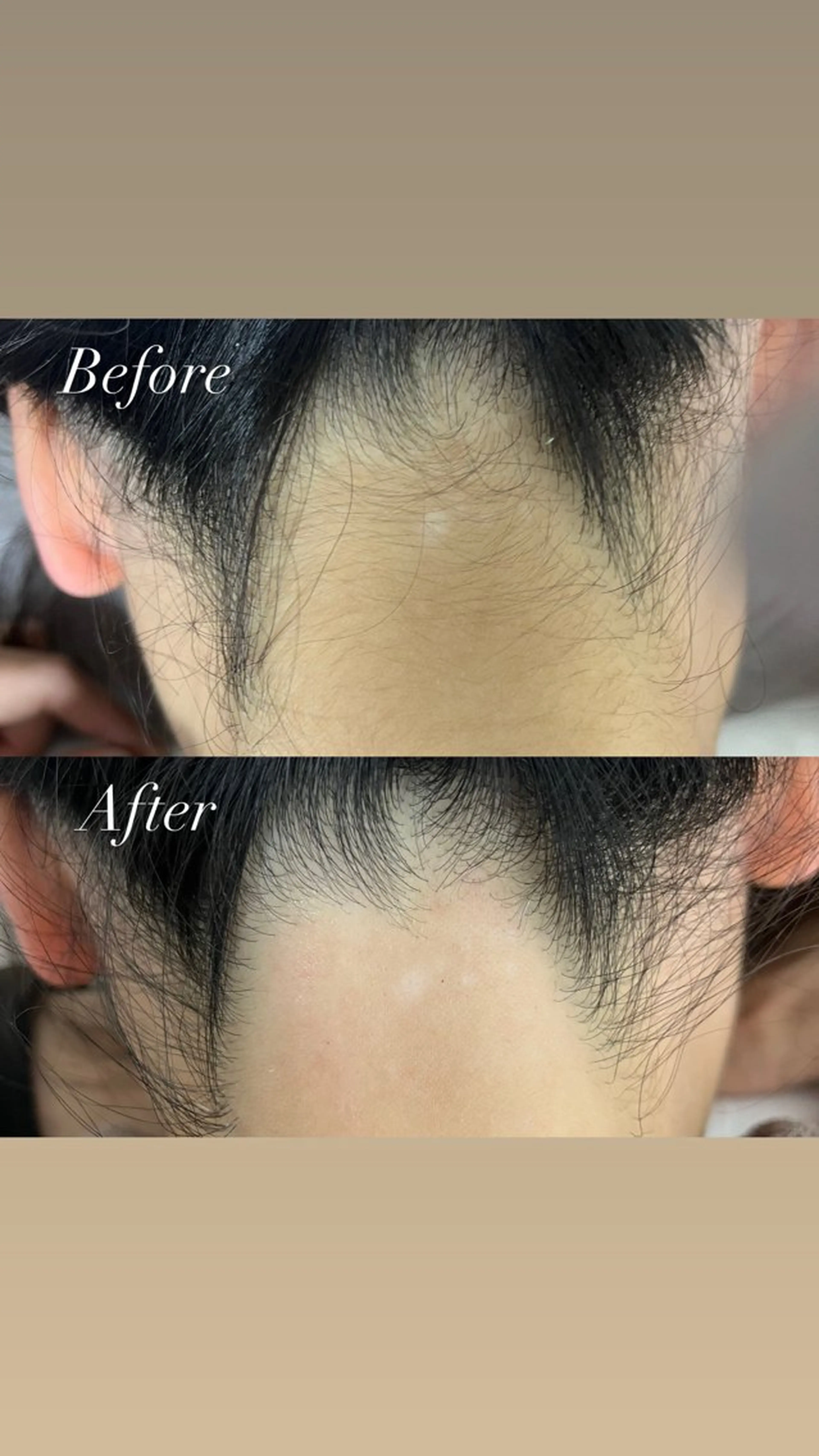 【女性全員】期間限定🌟うなじワックス＆うなじ光脱毛の写真