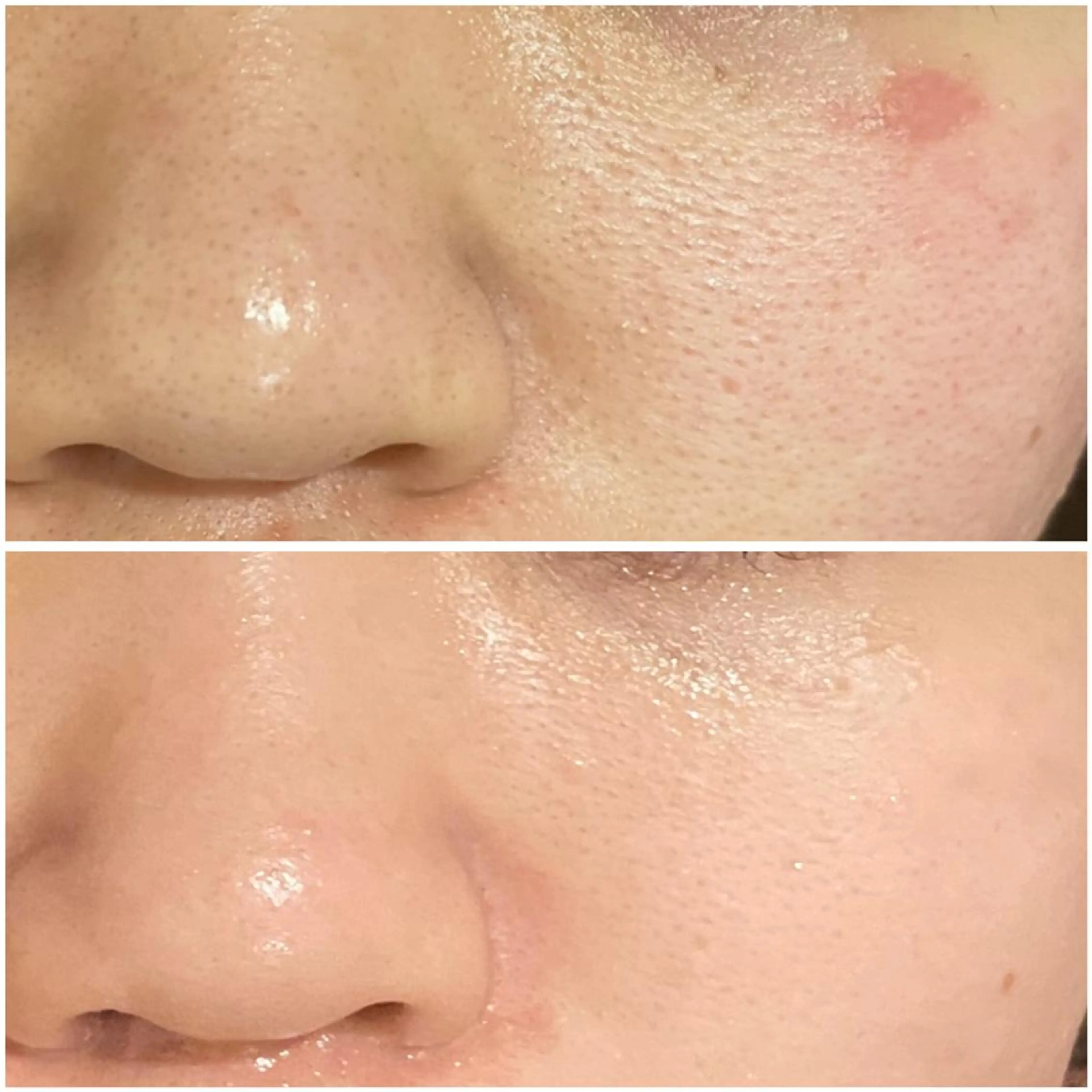 エステ リラク ニキビ跡改善専門🔥 医療にはできない改善のエステ・リラクイメージ