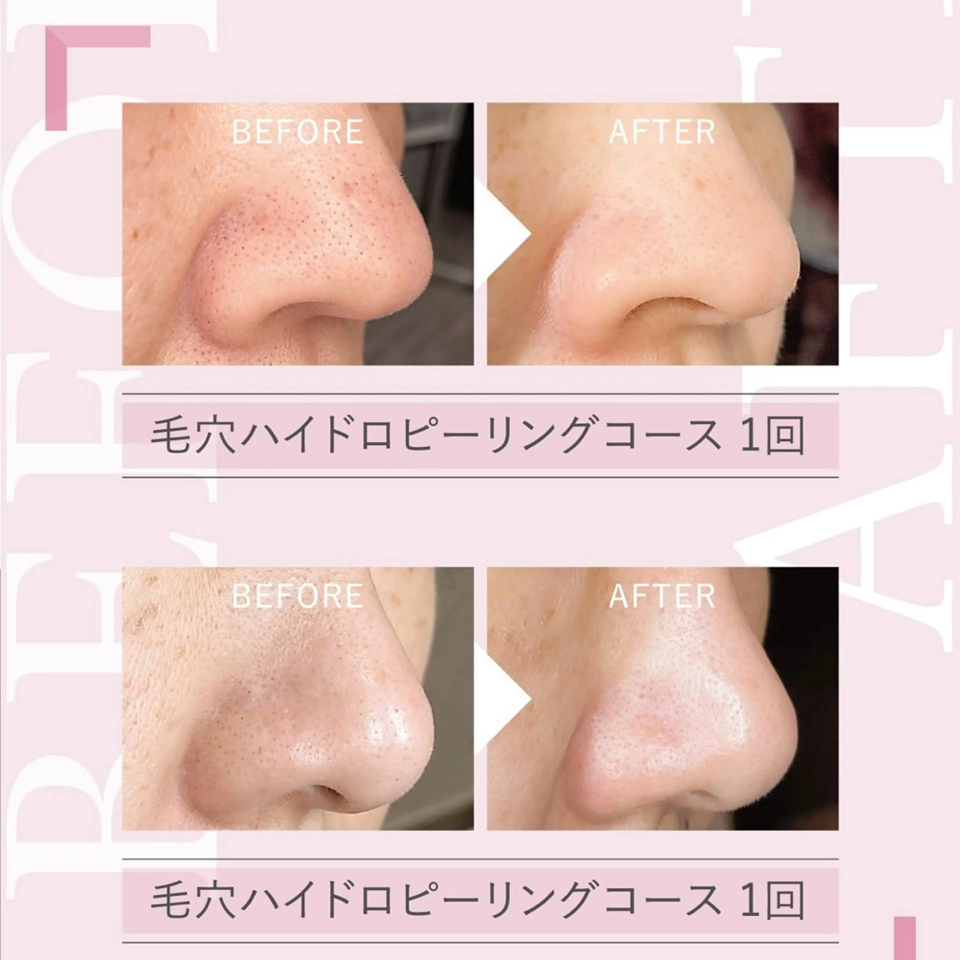 《メンズ大歓迎》韓国艶肌フェイシャル ¥8,800 → ¥3,500 毛穴洗浄＋ヒト幹細胞の写真