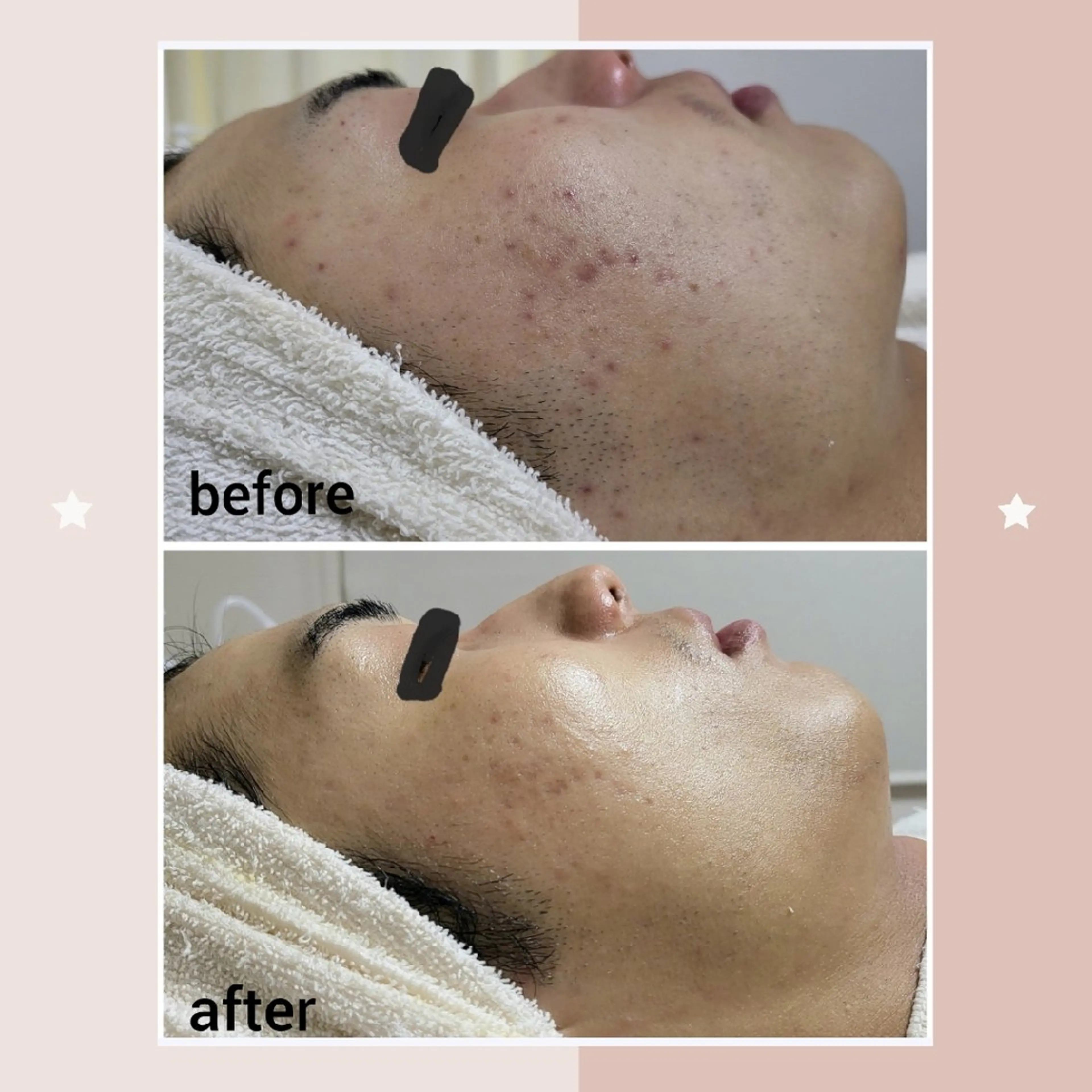 メンズ エステ ニキビケア＆ニキビ跡 レゾン京橋店　のエステ・リラクイメージ