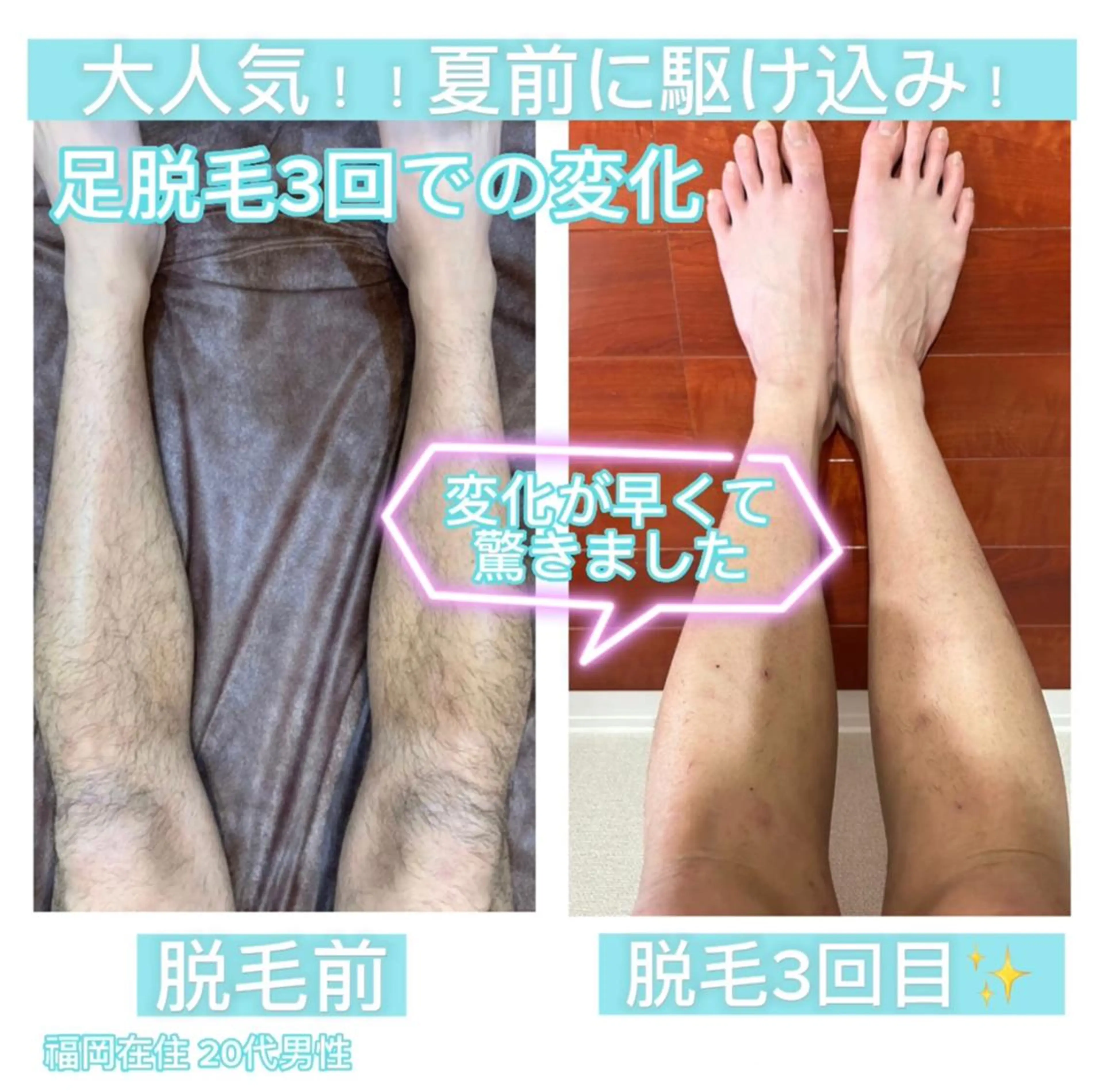🔹メンズ脱毛🔹足を出す季節🏝️ プロによる脱毛で自己処理しない夏を過ごしませんか？　しっかり３回コースの写真