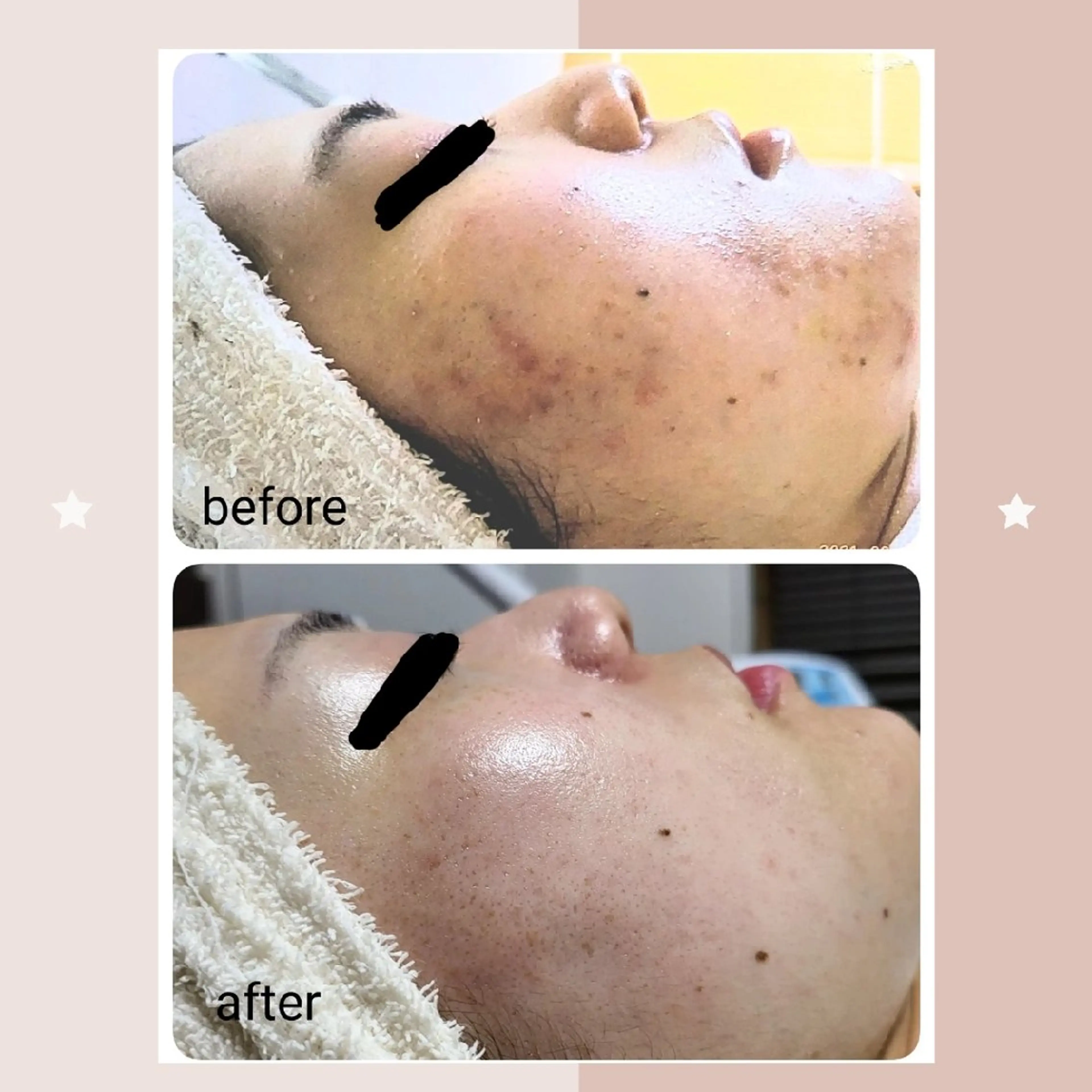 エステ ニキビケア&ニキビ跡 レゾン京橋店 のエステ・リラクイメージ