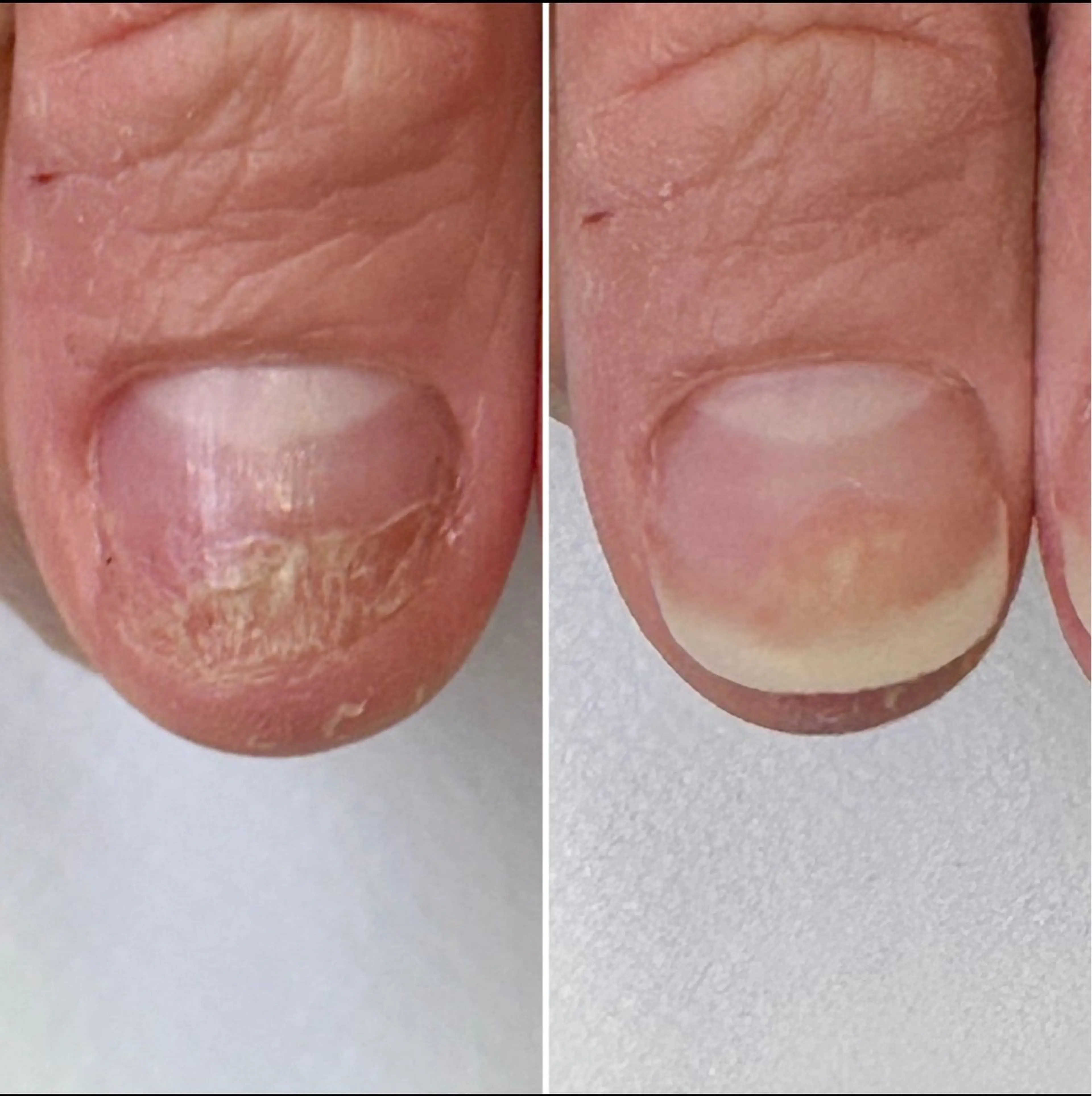 メンズ ネイル フットネイル 深爪矯正専門店　ネイルサロン　トイロ所属・ネイルサロン トイロのネイルデザイン