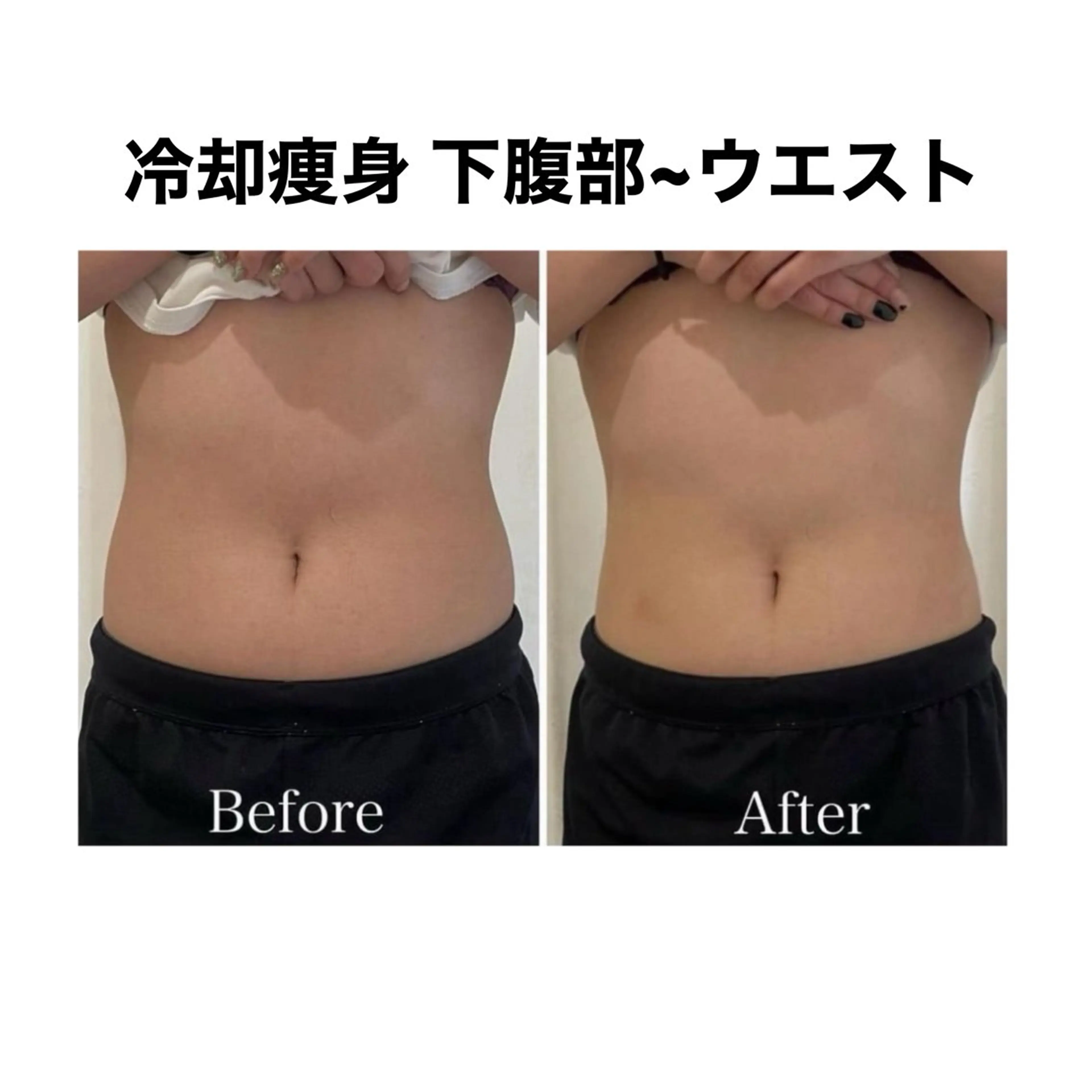 【7月限定‼️3名様】腰❄️冷却痩身 5回券の写真