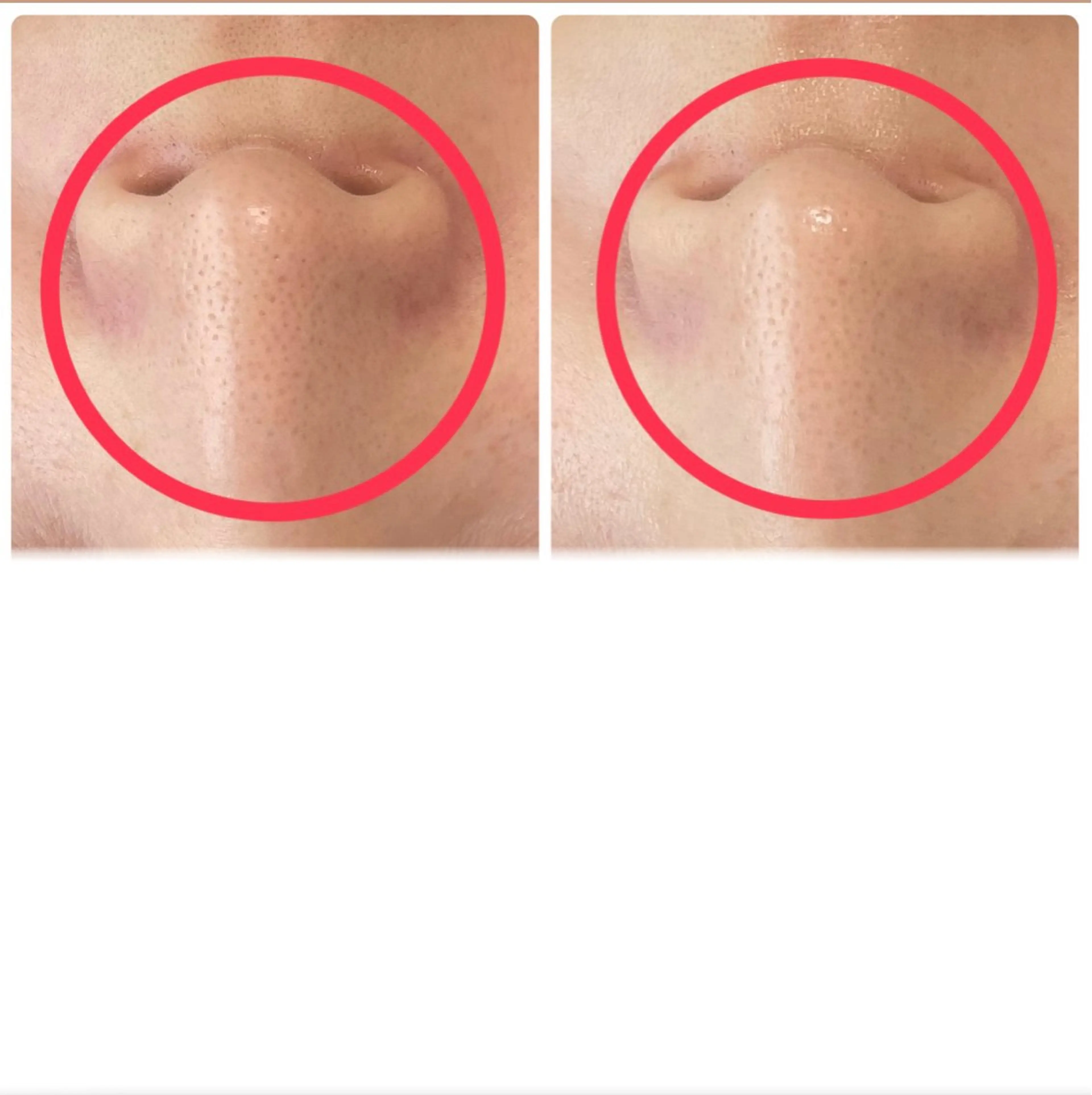 ハーブピーリング【毛穴、ニキビ】の写真