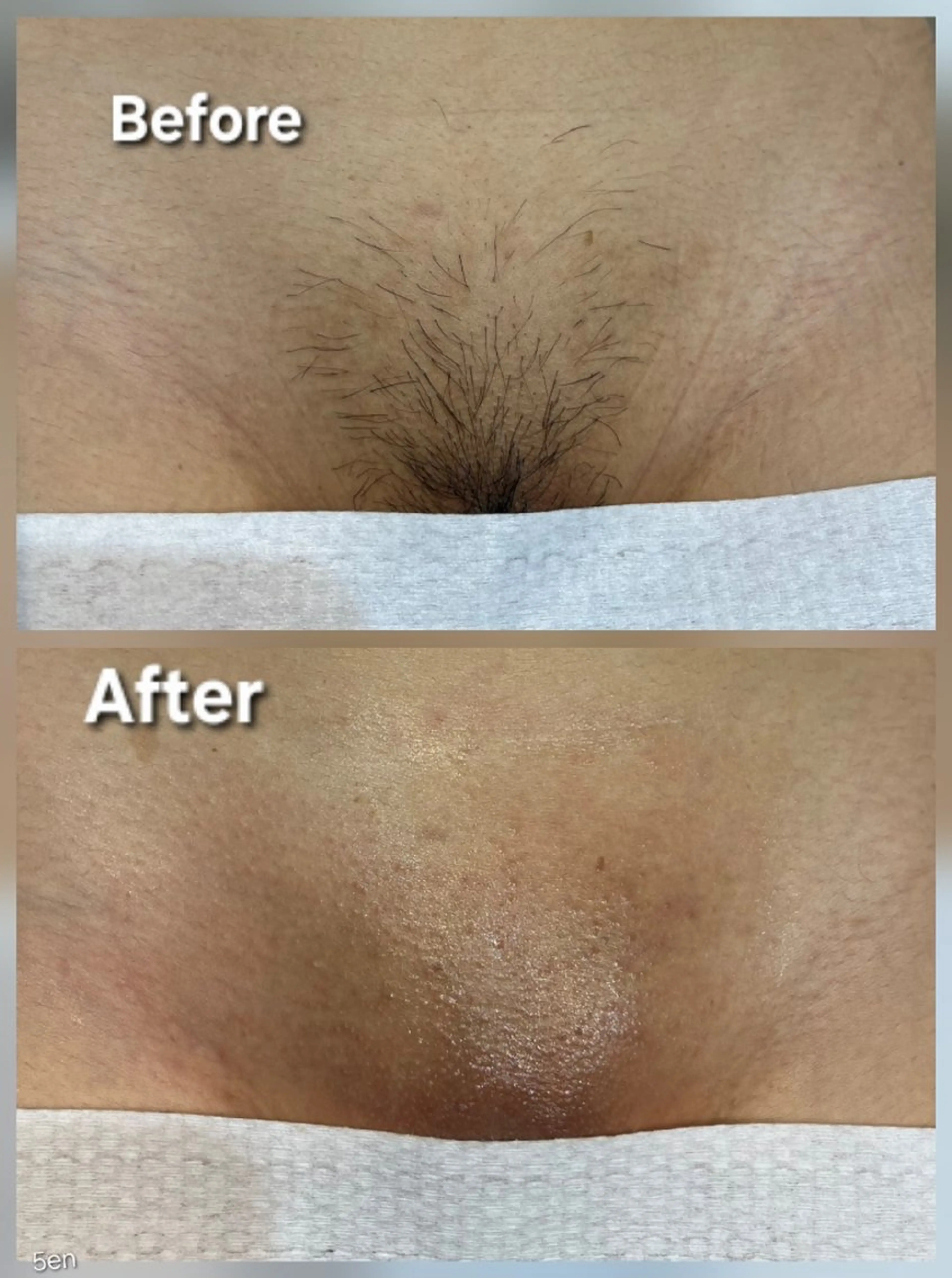 脱毛 シュガーリング/脱毛 EARLS三軒茶屋のエステ・リラクイメージ