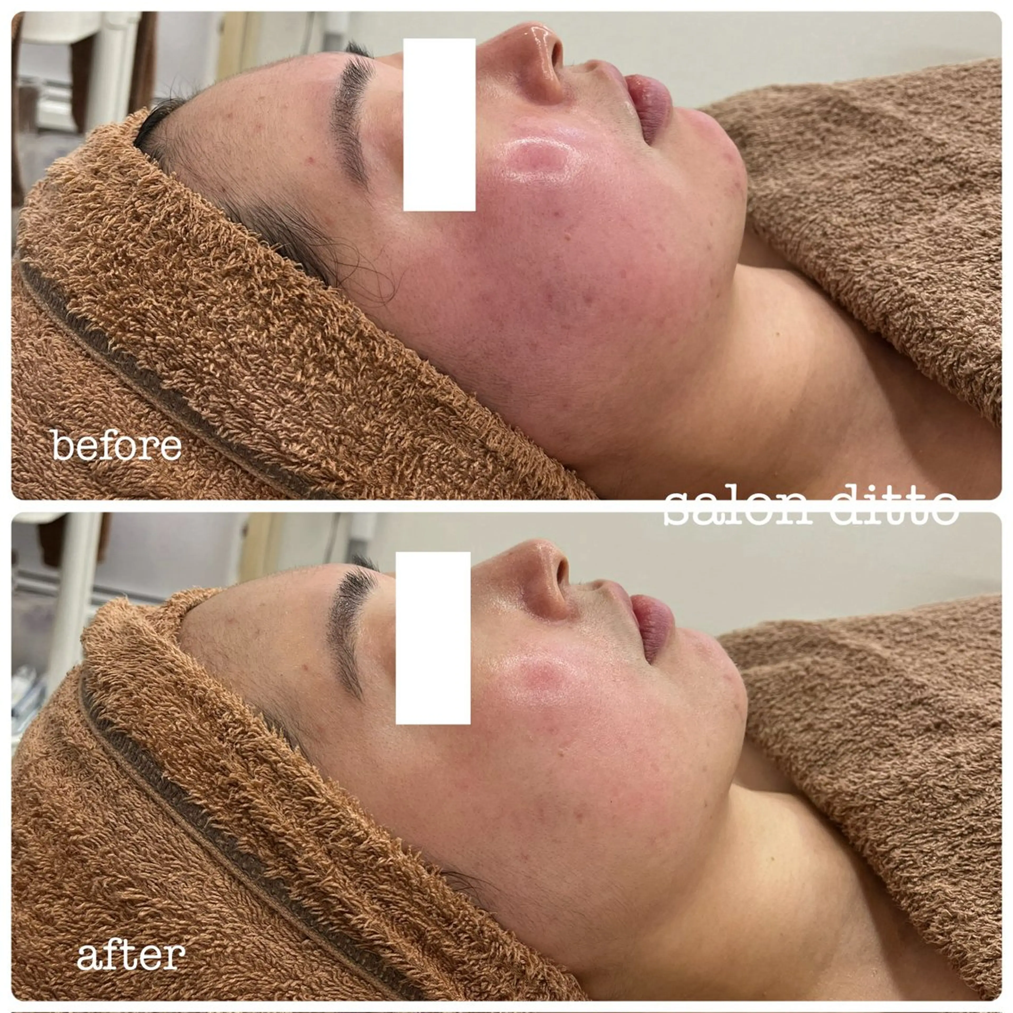 人気No.2【minimo限定】小顔コルギ＋肩甲骨ほぐし(75分)の写真