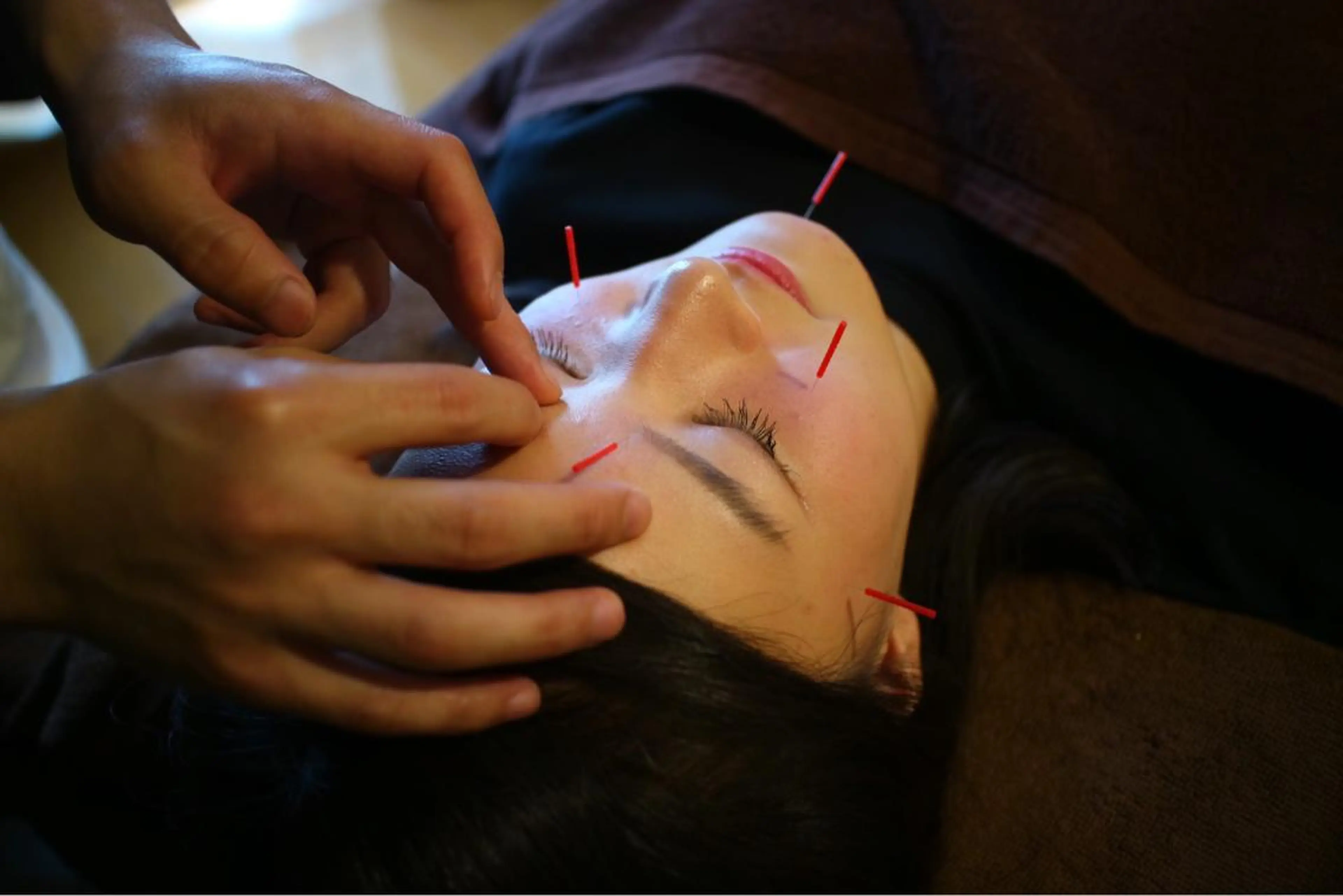 【初回限定】お試し価格の美容鍼！！😳✨美容鍼ってどんなの！？って思った方！ぜひ一度受けてみてください^ ^の写真