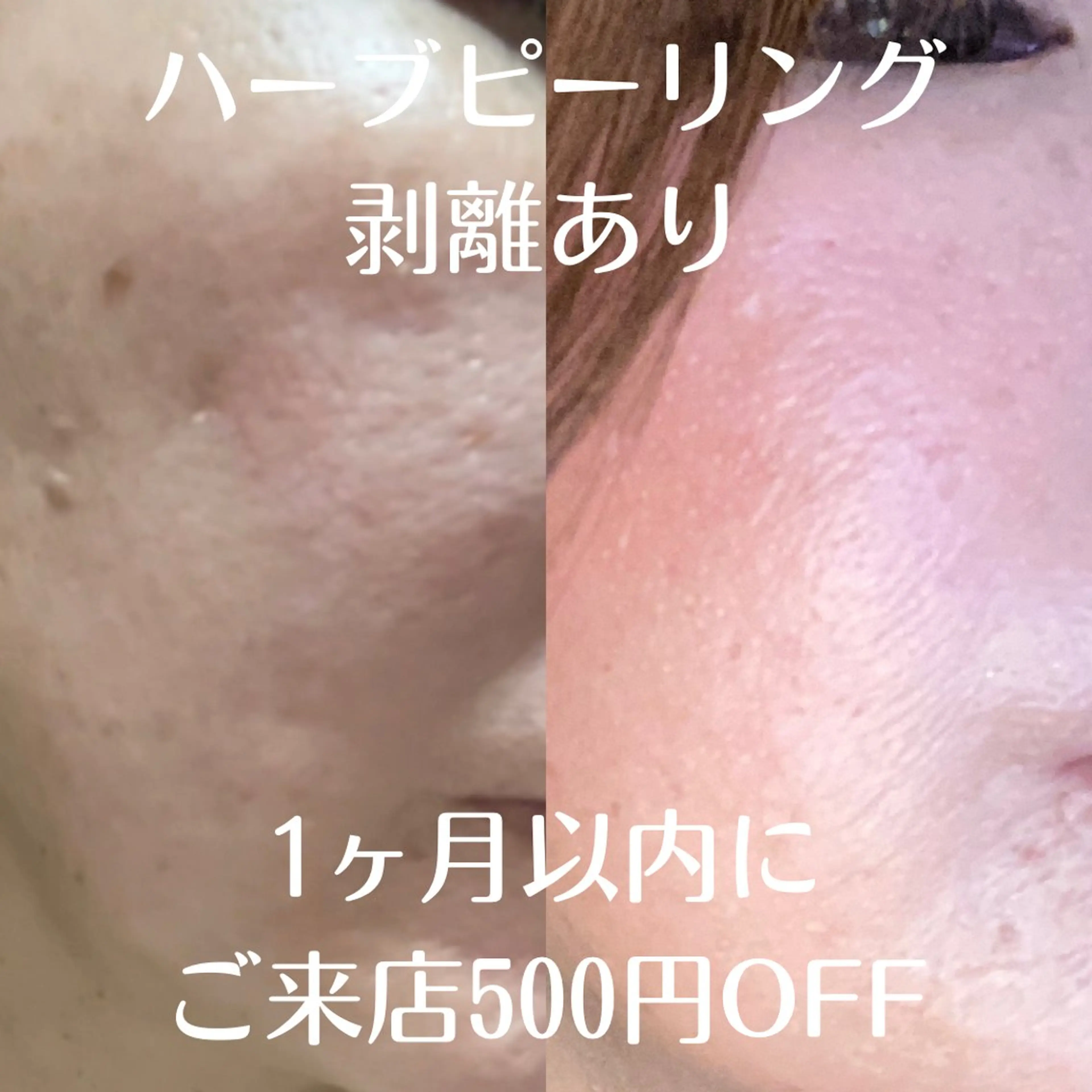 ハーブピーリング1ヶ月以内にご来店【500円OFF】の写真