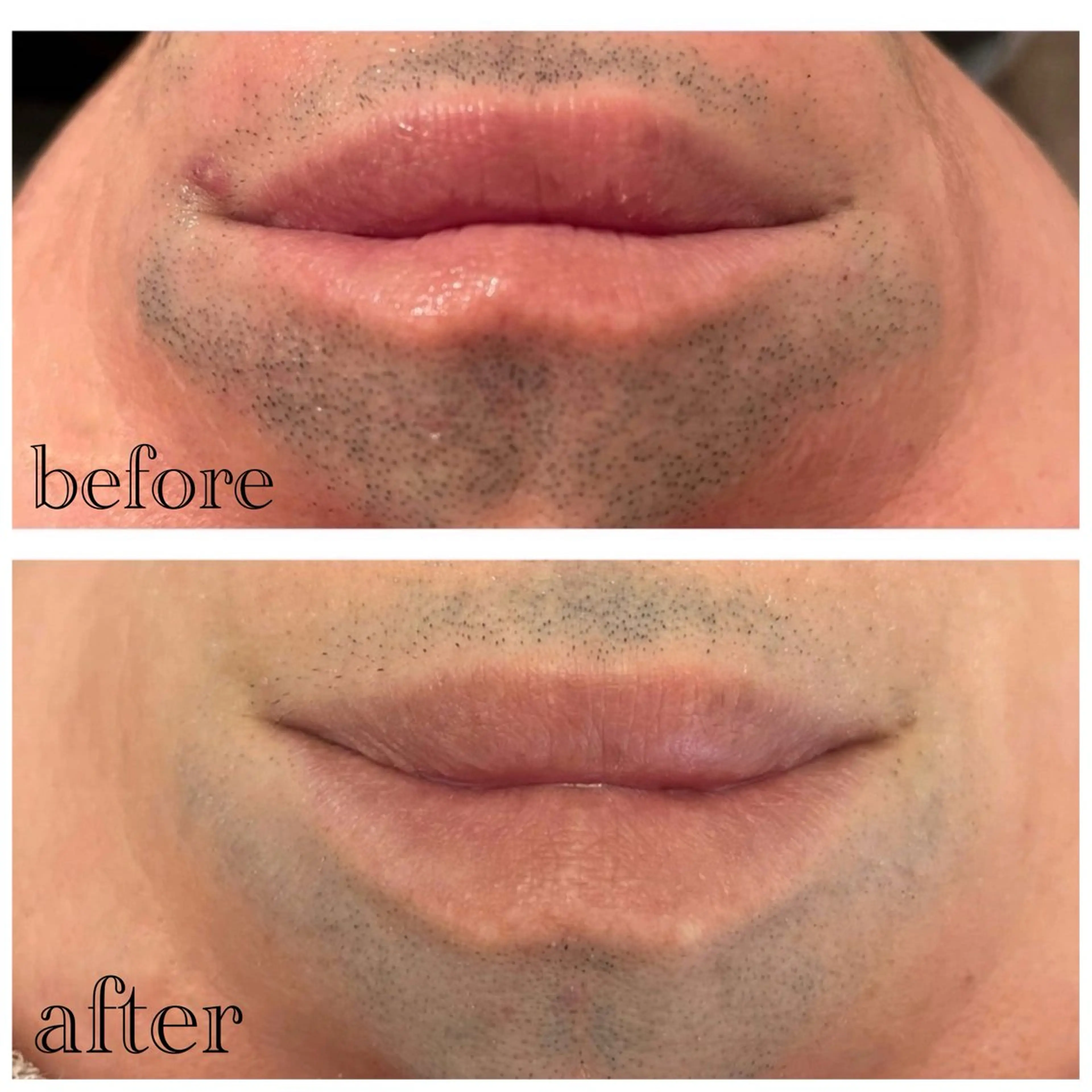 大人気✨✨メンズ髭脱毛の写真