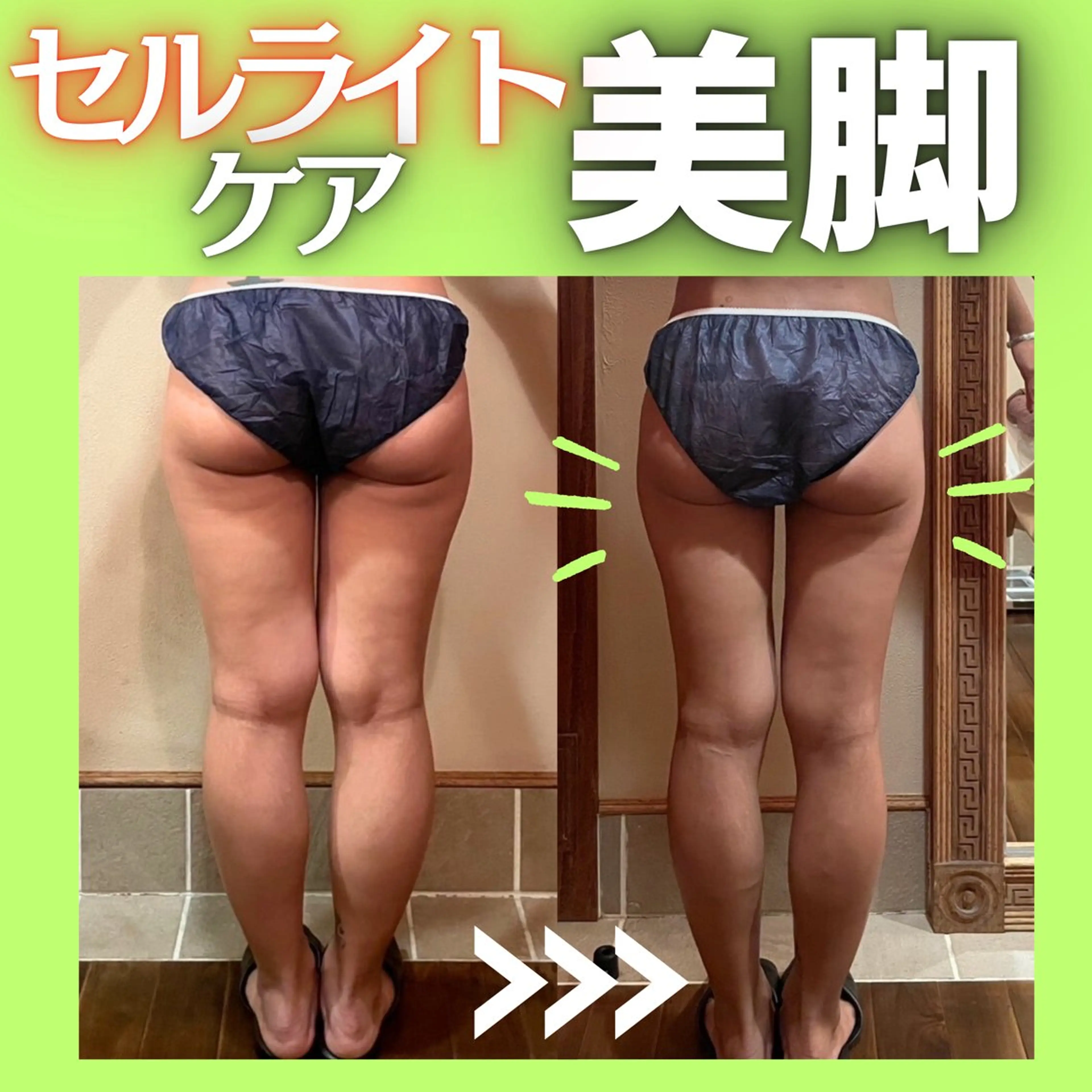 ＼太もも・ヒップのもたつきが気になる方に／最強マシンで頑固なセルライトにアタック🫧引き締まった美脚に✨の写真