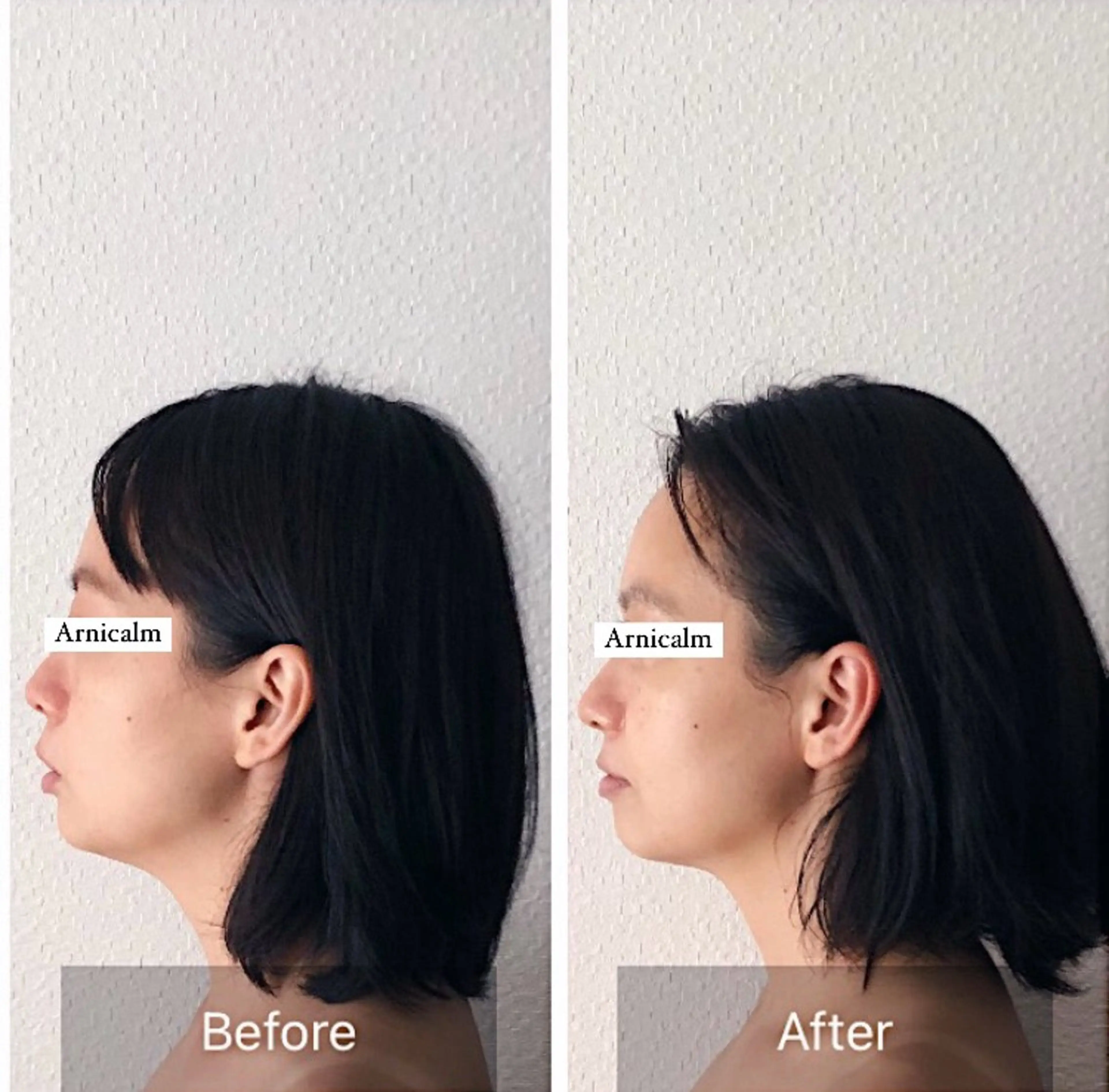 エステ ハーブピーリング 肌再生ピーリング/のエステ・リラクイメージ