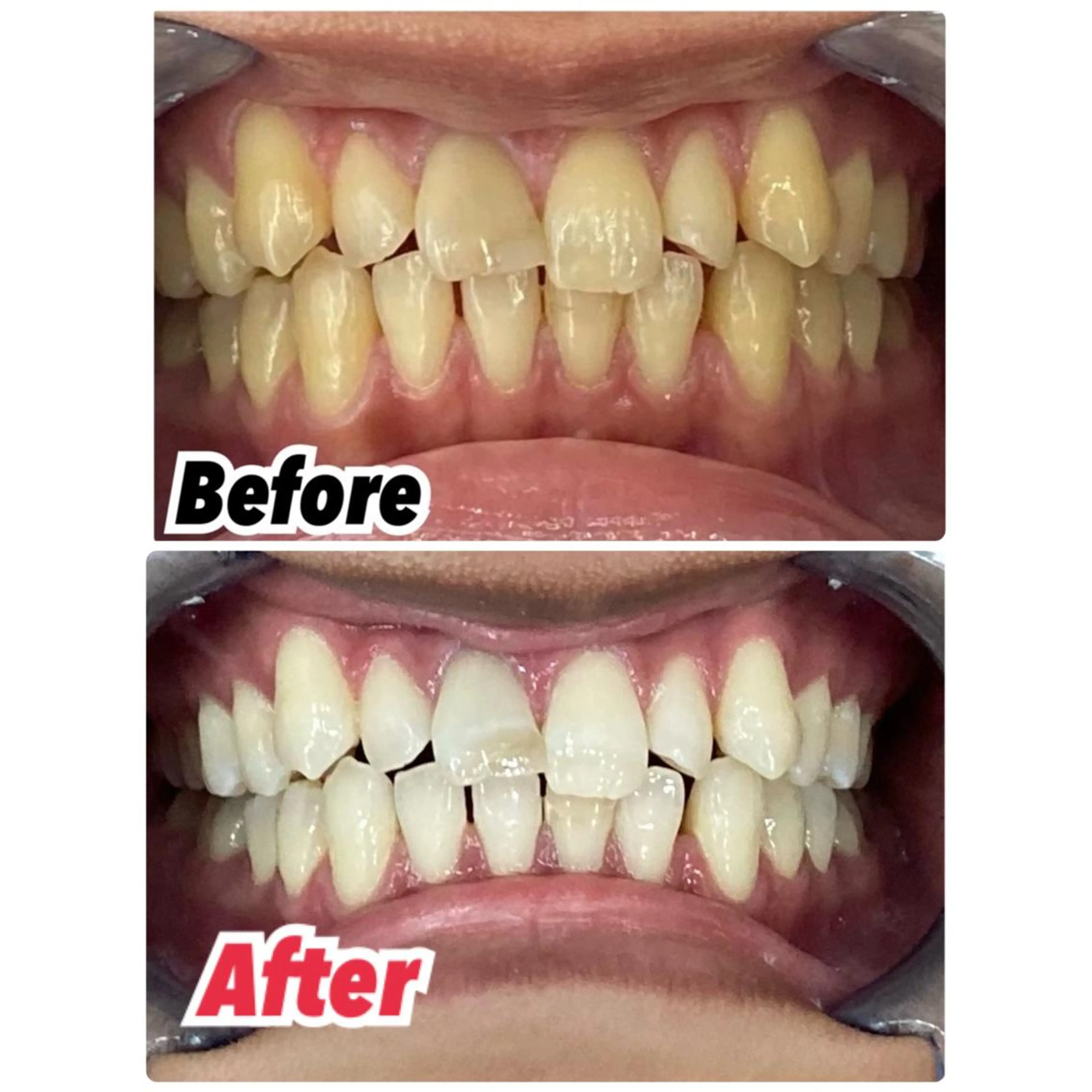 キッズ ネイル アイブロウ ラメ(グリッター) プラチナムビューティー柏所属・【歯科提携】柏ホワイ トニングスタイルのその他イメージ