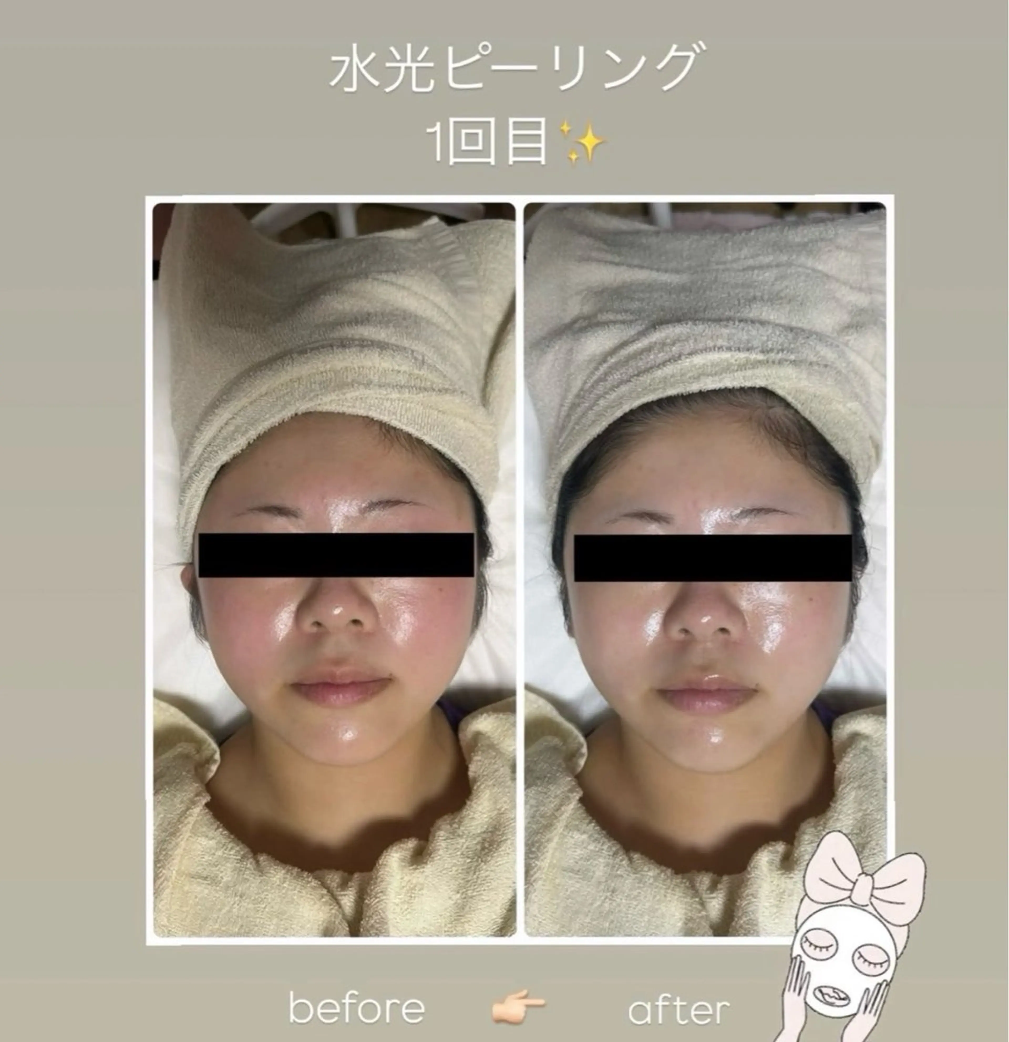 剥離なし❣️渡韓なし❣️韓国肌ケア人気No.1✨【水光ピーリング】➕ヘッド➕デコルテマッサージ付き💆🏻‍♀️の写真
