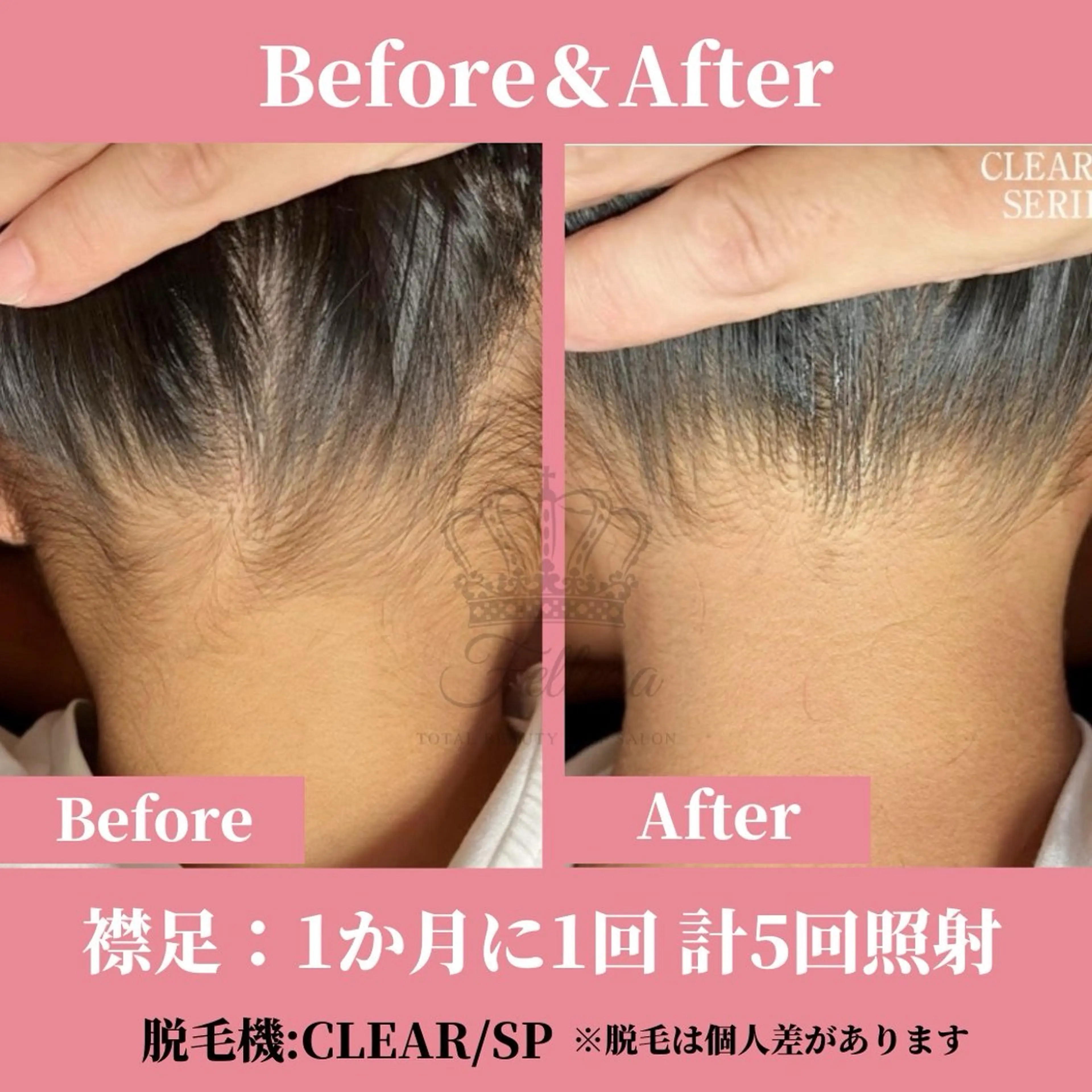 キッズ 有人型セルフサロン 脱毛/痩身/美顔のその他イメージ