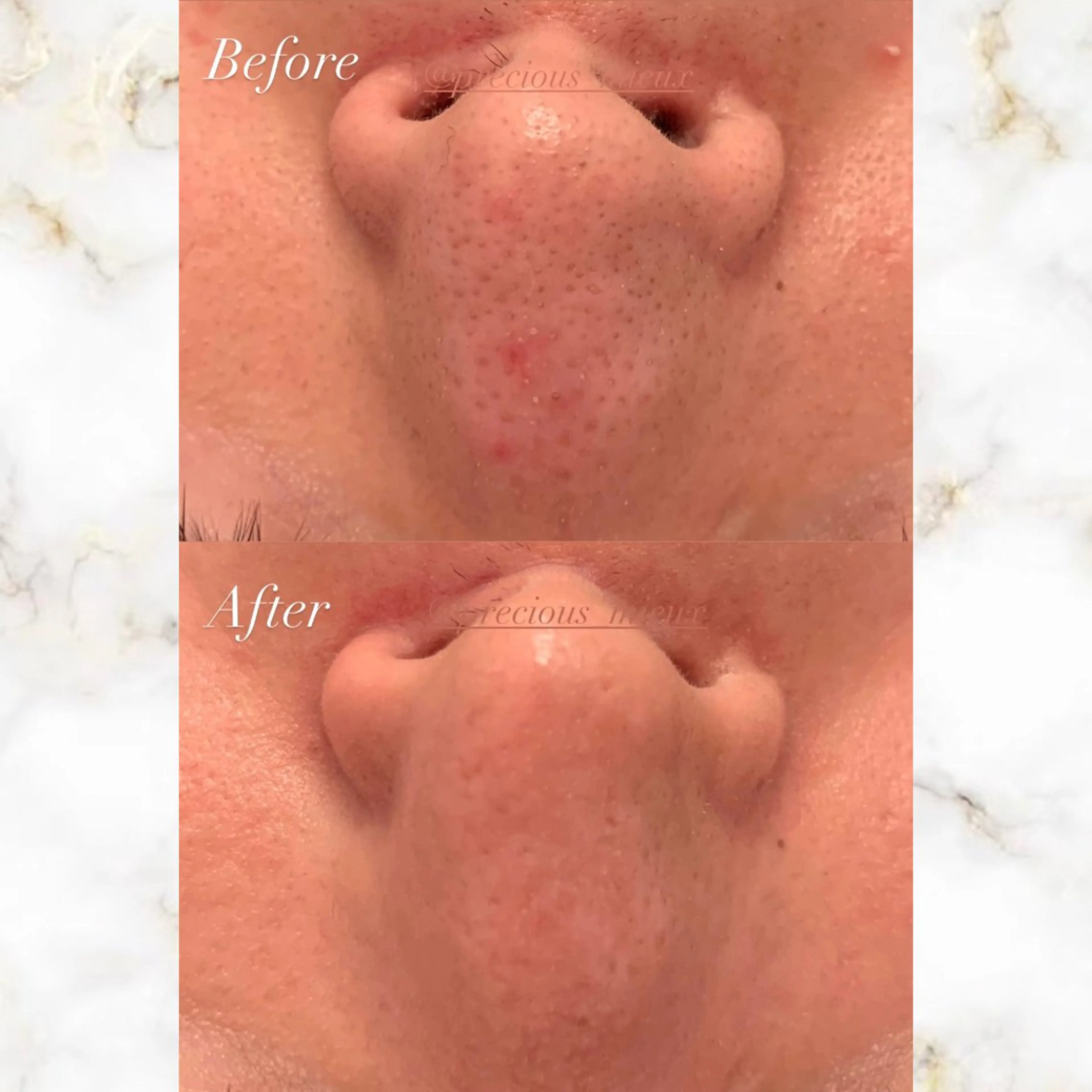 【ピッカピカ✨お肌の大掃除🫧】毛穴ケアとピーリングのセット🉐ピーリング前に毛穴の掃除をするとピーリング浸透率2倍‼️の写真