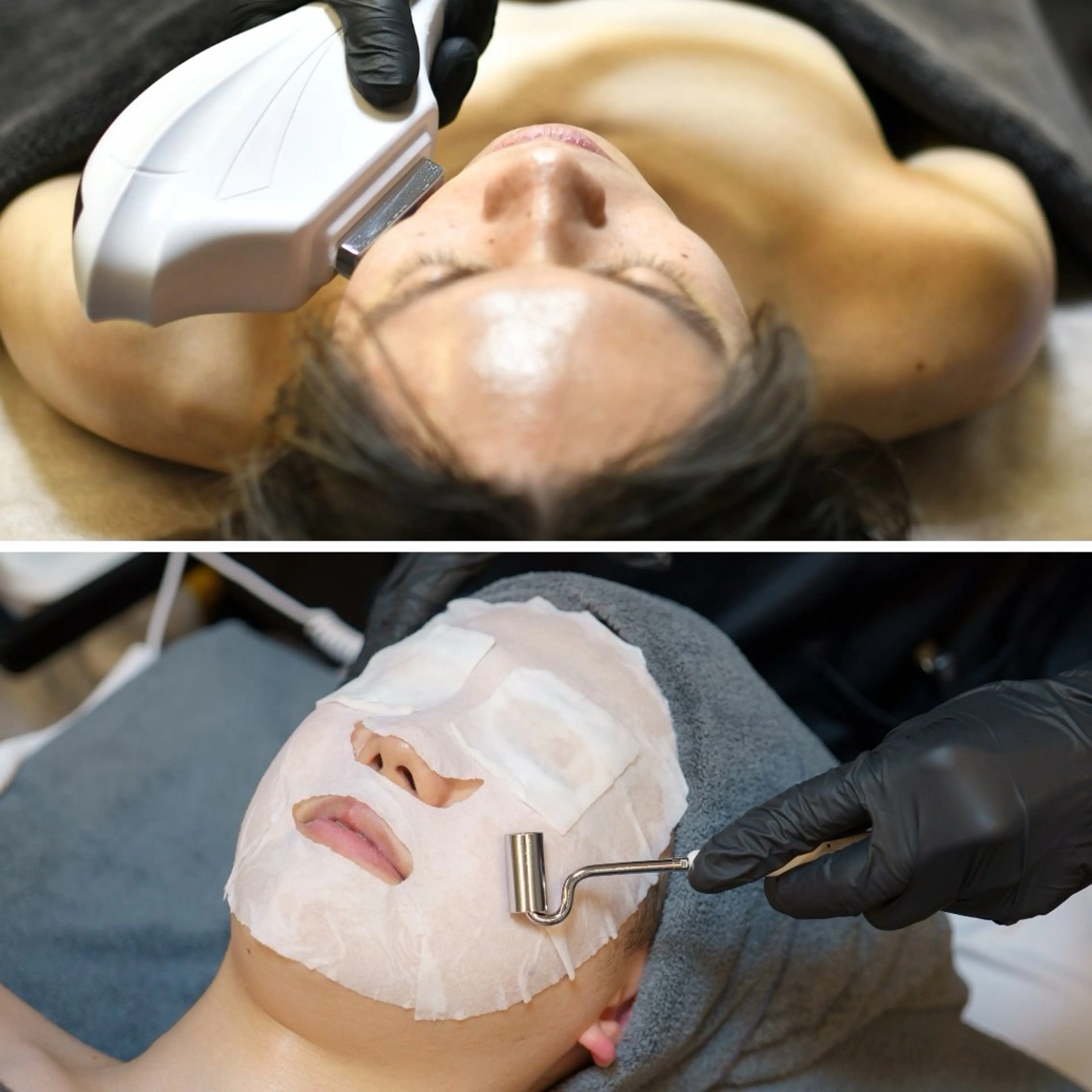 【メンズ限定】ヒゲ脱毛（お顔全体​〜​首下含む）＋イオン導入✨【セット🈹】の写真