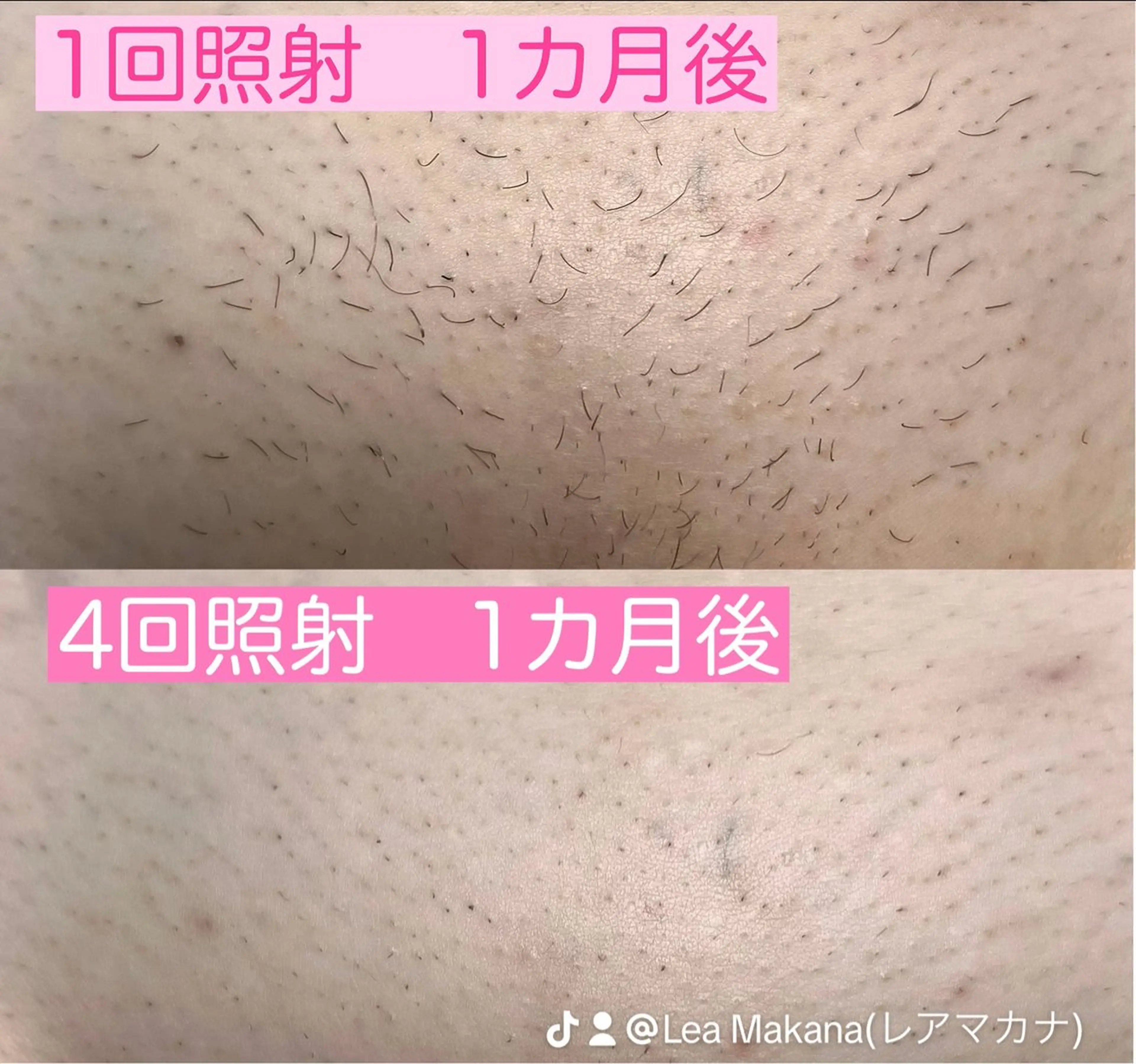 初回限定【VIO脱毛】カウンセリング込◎ニオイ、蒸れからの解放◎ストレスフリーな生活へ✨介護脱毛をお考えの方の写真
