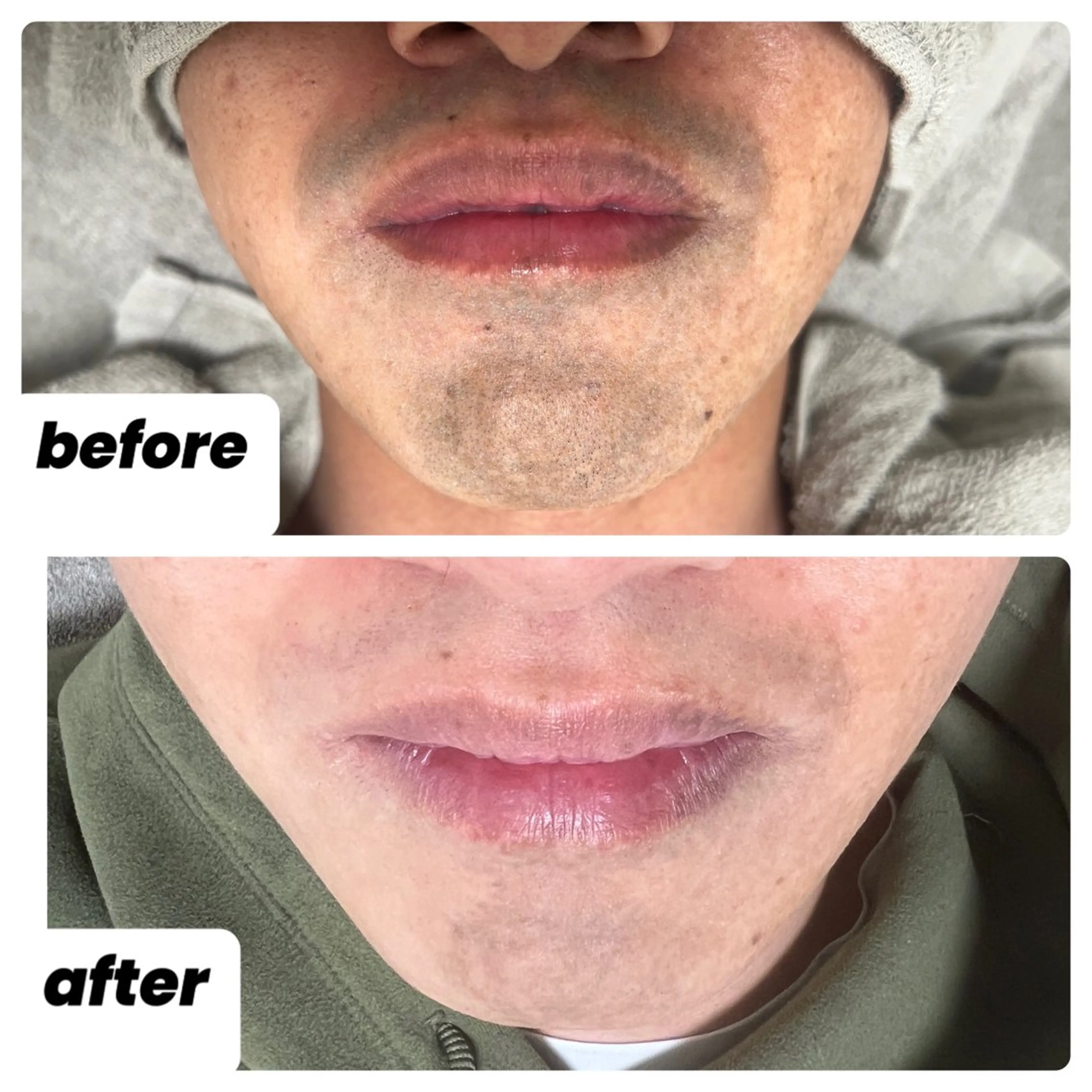 初回ヒゲ脱毛1回の写真