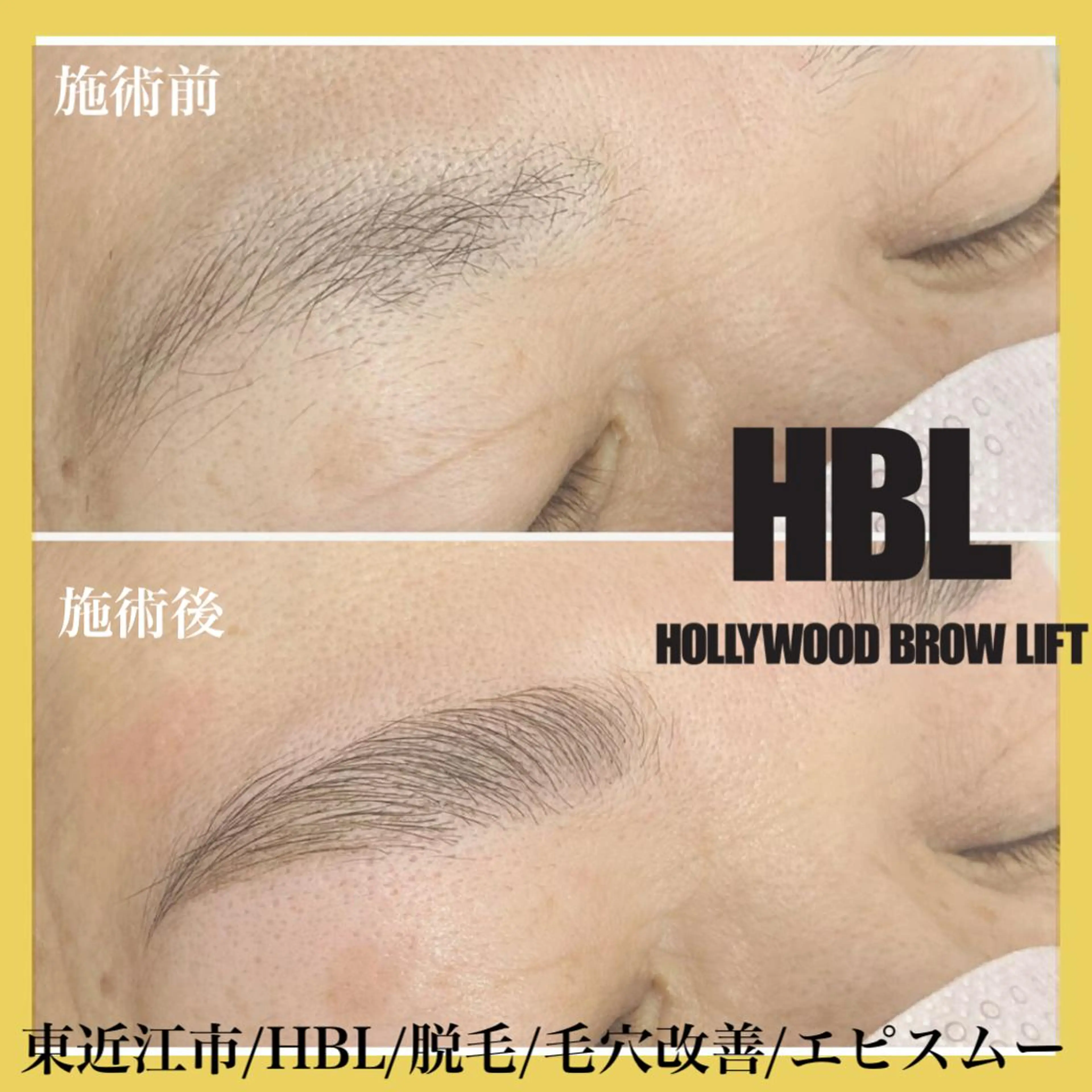 アイブロウ その他(アイブロウ) epismoo 脱毛/HBL/毛穴の眉毛・アイブロウイメージ