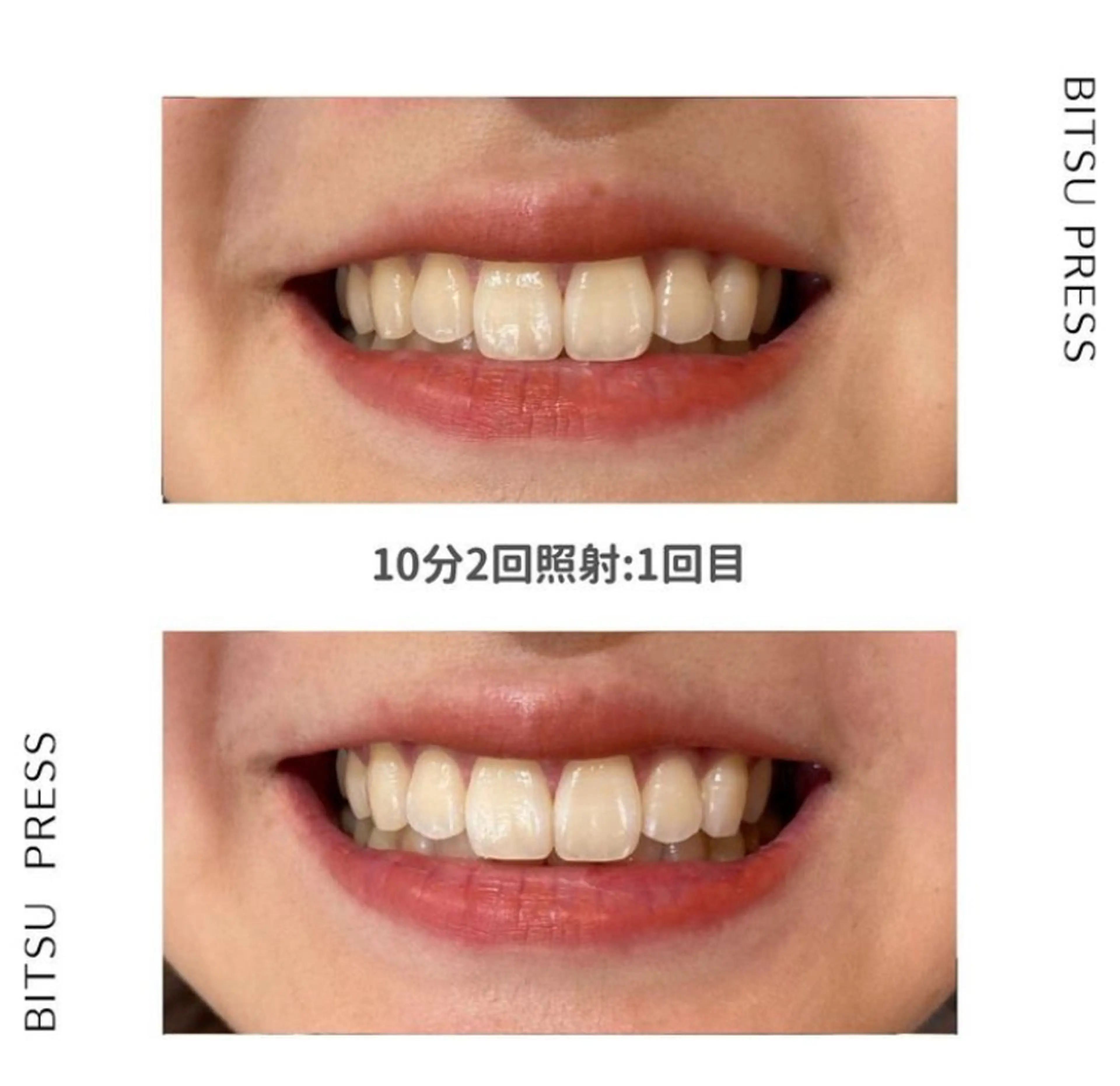 セルフホワイトニング付き🦷最新ハイブリッド脱毛※全身全顔からパーツを選べる✨(10分照射1回)の写真