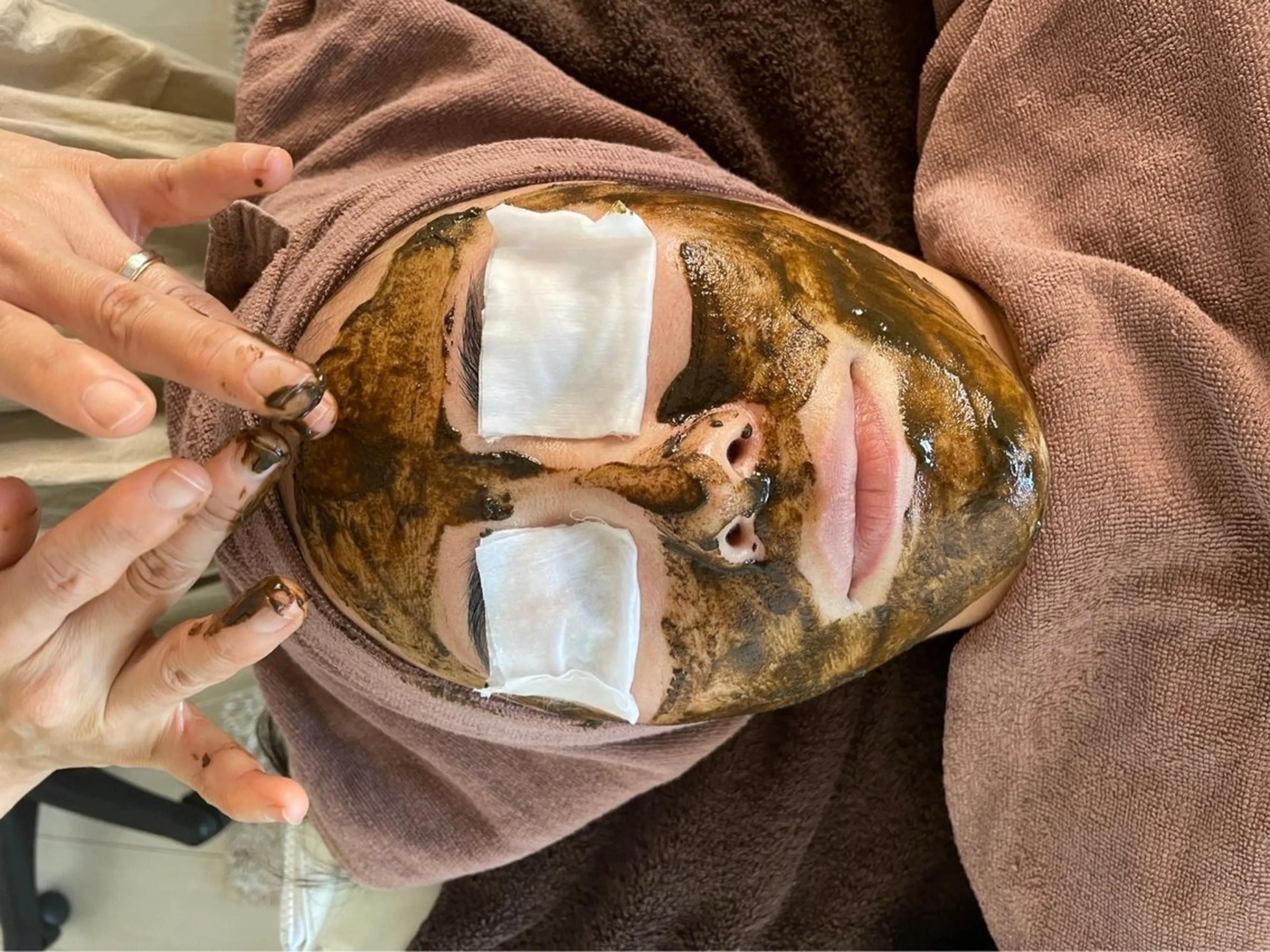 ナークハーブピーリングの写真