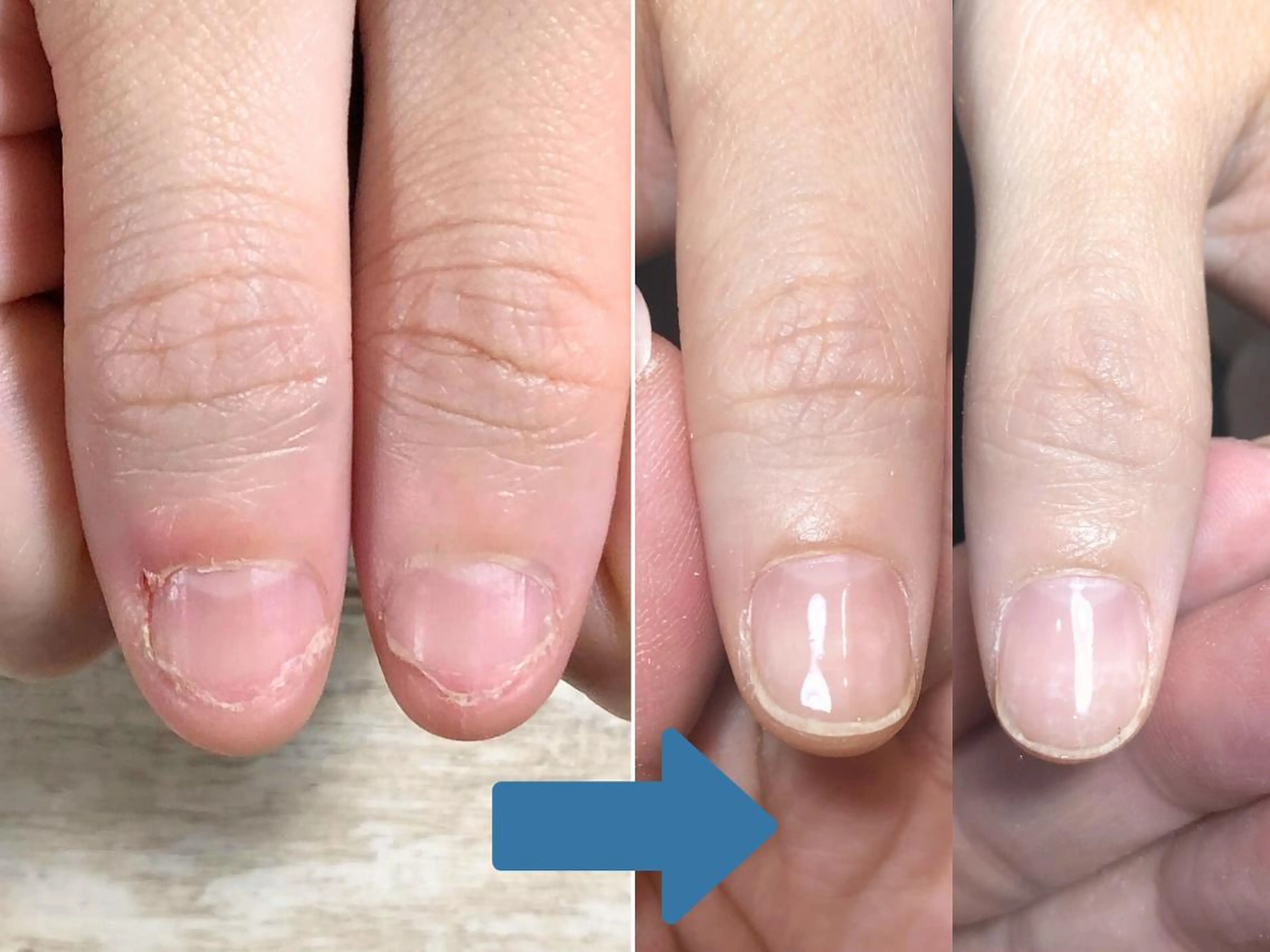 ネイル 深爪矯正・自爪育成 ネイルサロンアモまいのネイルデザイン